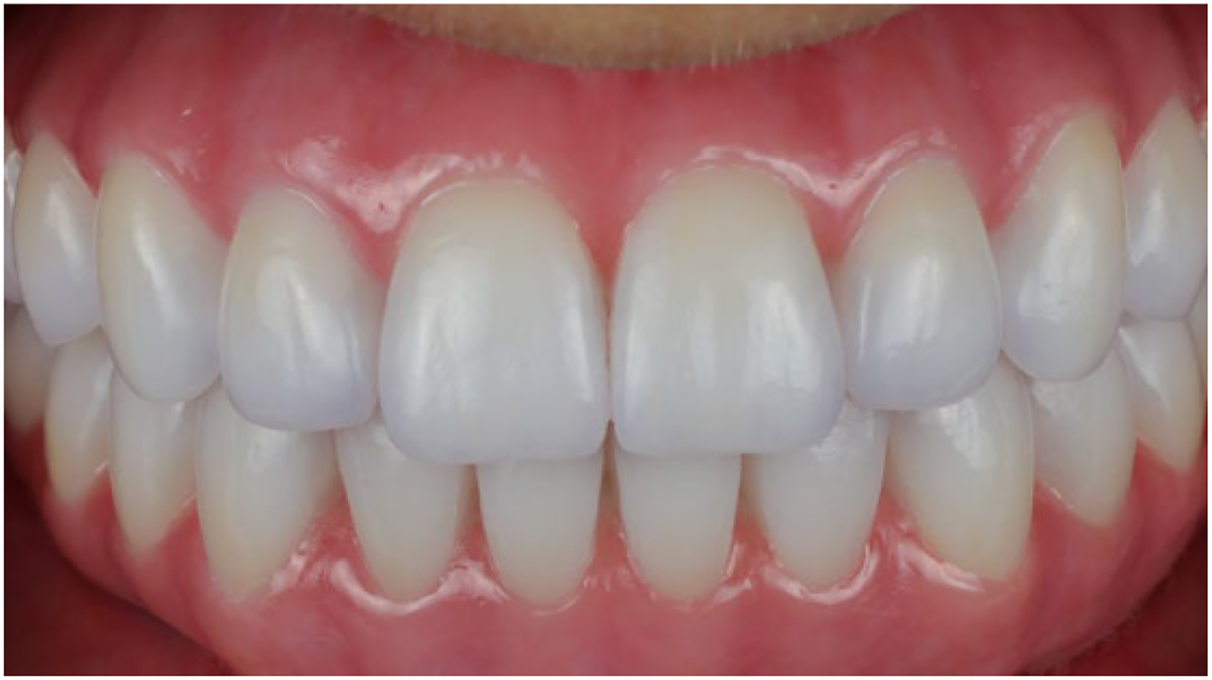 A clinical photo shows a dental prosthesis with teeth and metal attachments in an open mouth.