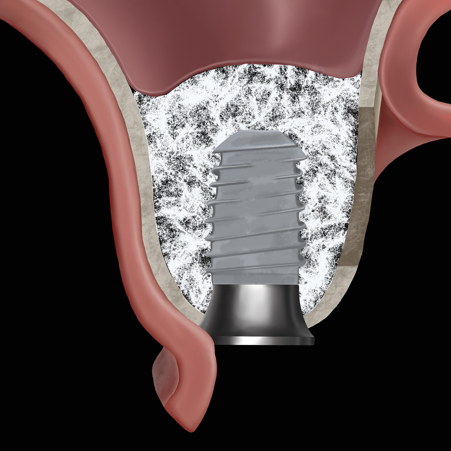 A clinical illustration of a collagen matrix placed around a dental implant and sinus stabilizer abutment in the maxillary sinus after membrane elevation.