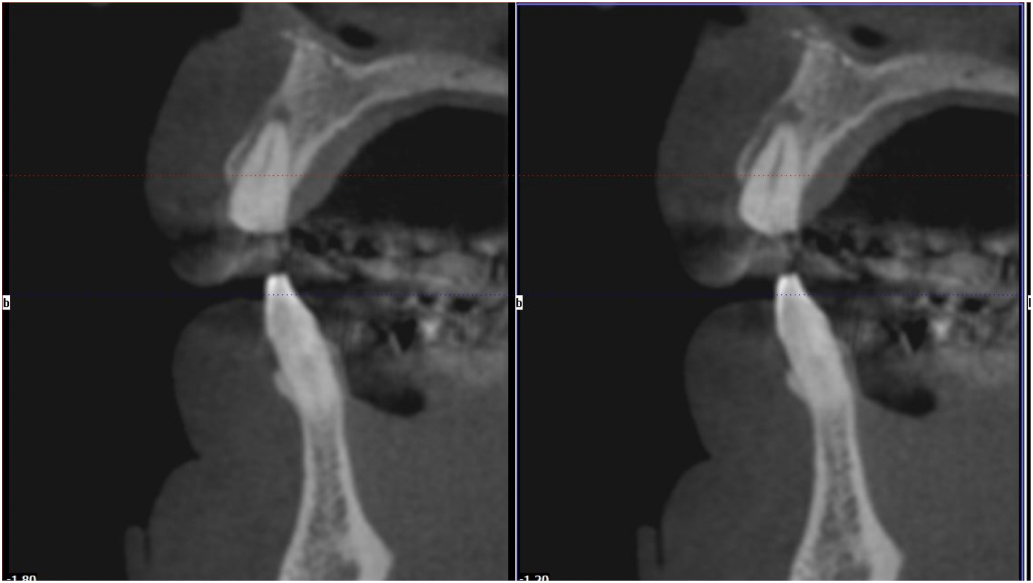 A set of two identical c b c t scans, side by side, shows a buccal and apical infection. A dark, radiolucent area is visible adjacent to a remaining root structure in the upper jaw.