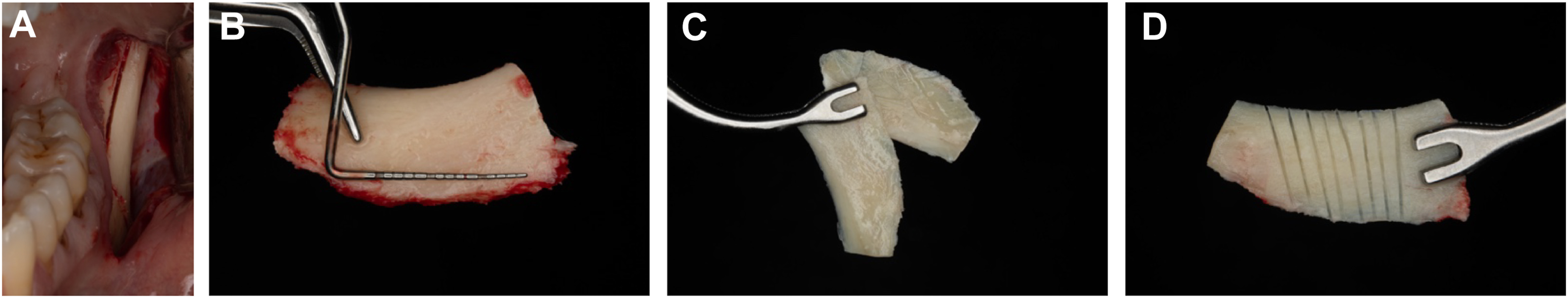 Four dental photos show harvesting a bone block from the mandibular ramus, splitting it into two plates, and creating kerfs to allow controlled bending for ridge reconstruction.