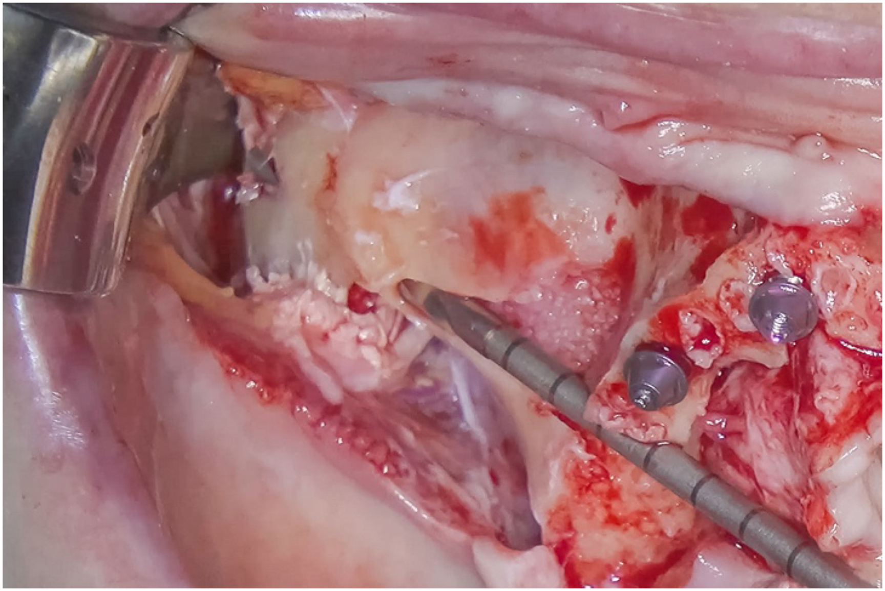 A photo shows a completed osteotomy with one tool and two screws in exposed tissue.