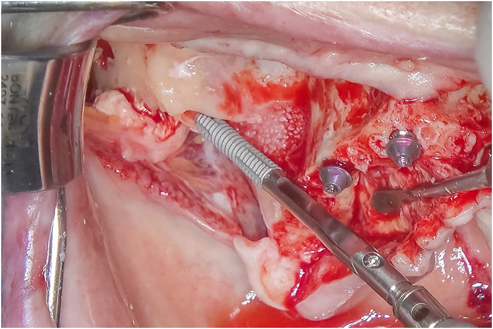 A photo shows a Straumann Z A G A Flat implant with two tools and two screws in exposed tissue.