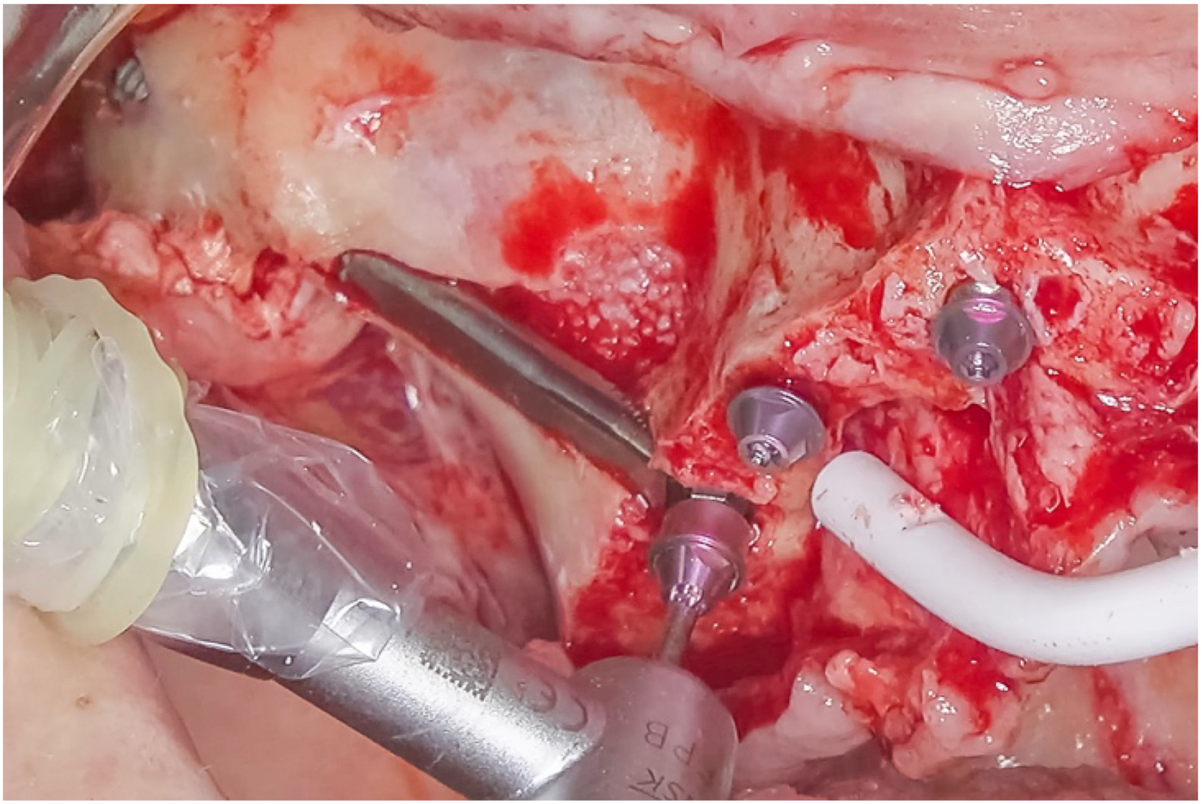 A photo shows a 2 millimeter S R A fitted with two tools and three screws in exposed tissue.