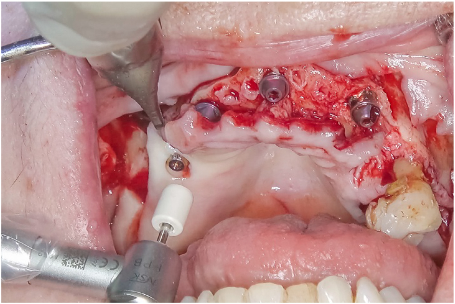 Intraoral surgical view shows soft tissue repositioned over ridge and around implant heads, tissue contours adapted to underlying implant framework.