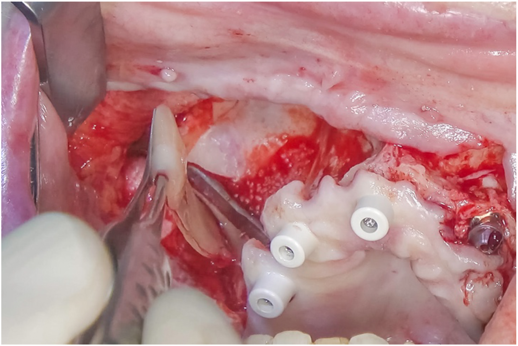 A surgical photo shows no grafting over the buccal of an implant with two tools and three screws in exposed tissue.