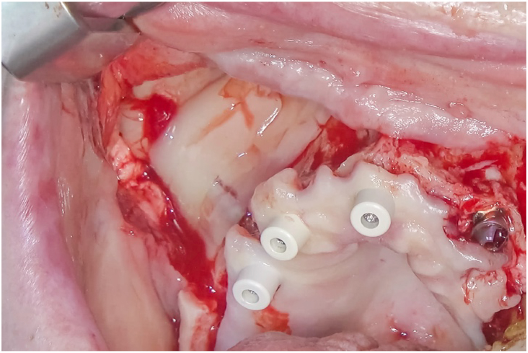 A surgical photo shows P R F applied with one tool and three screws in exposed tissue.