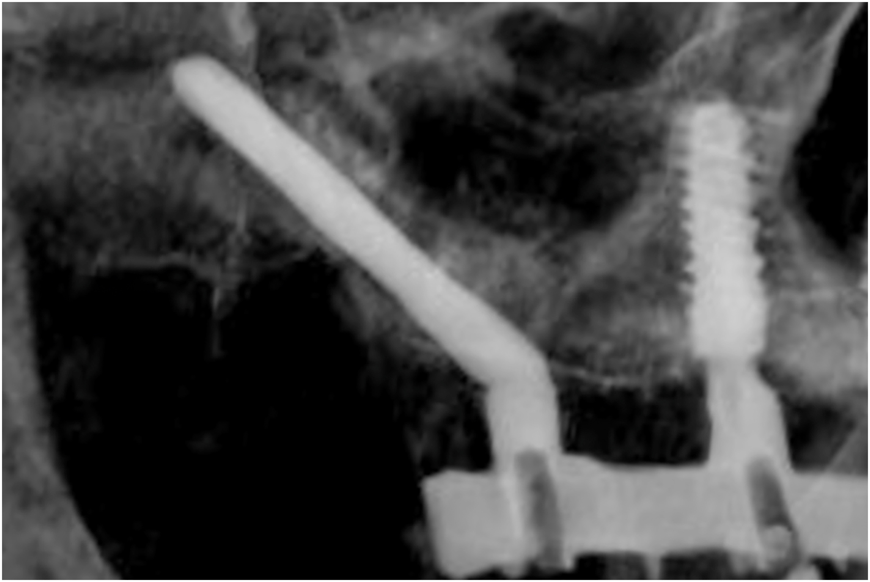 Radiograph shows angled cheekbone implant connected to rigid bar, continuous bone density along implant length, and prosthetic connection visible at implant head.