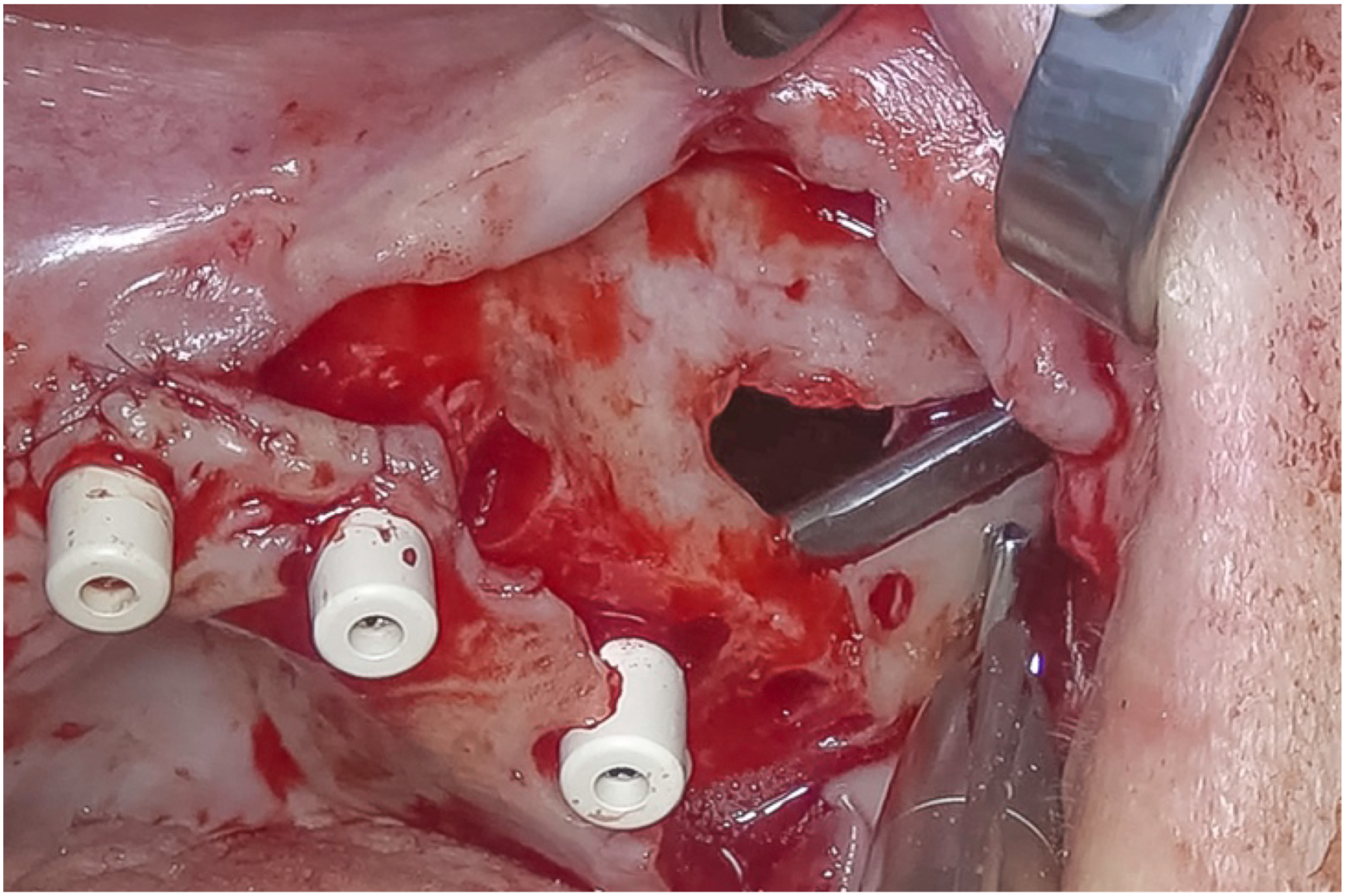 A clinical photo shows a large perforation in a patients mouth during a surgical procedure, with three cylindrical implants and a metal instrument visible.