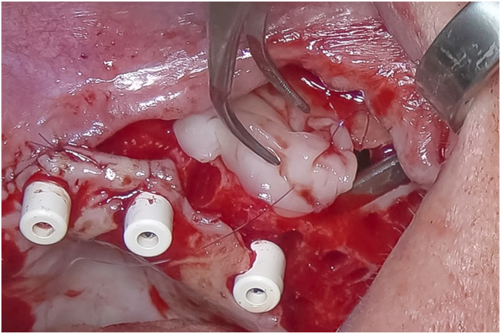 A clinical photo shows three pinholes in the bone near an implant, with a thick layer of material sutured to the holes and lining the implant inside a sinus.