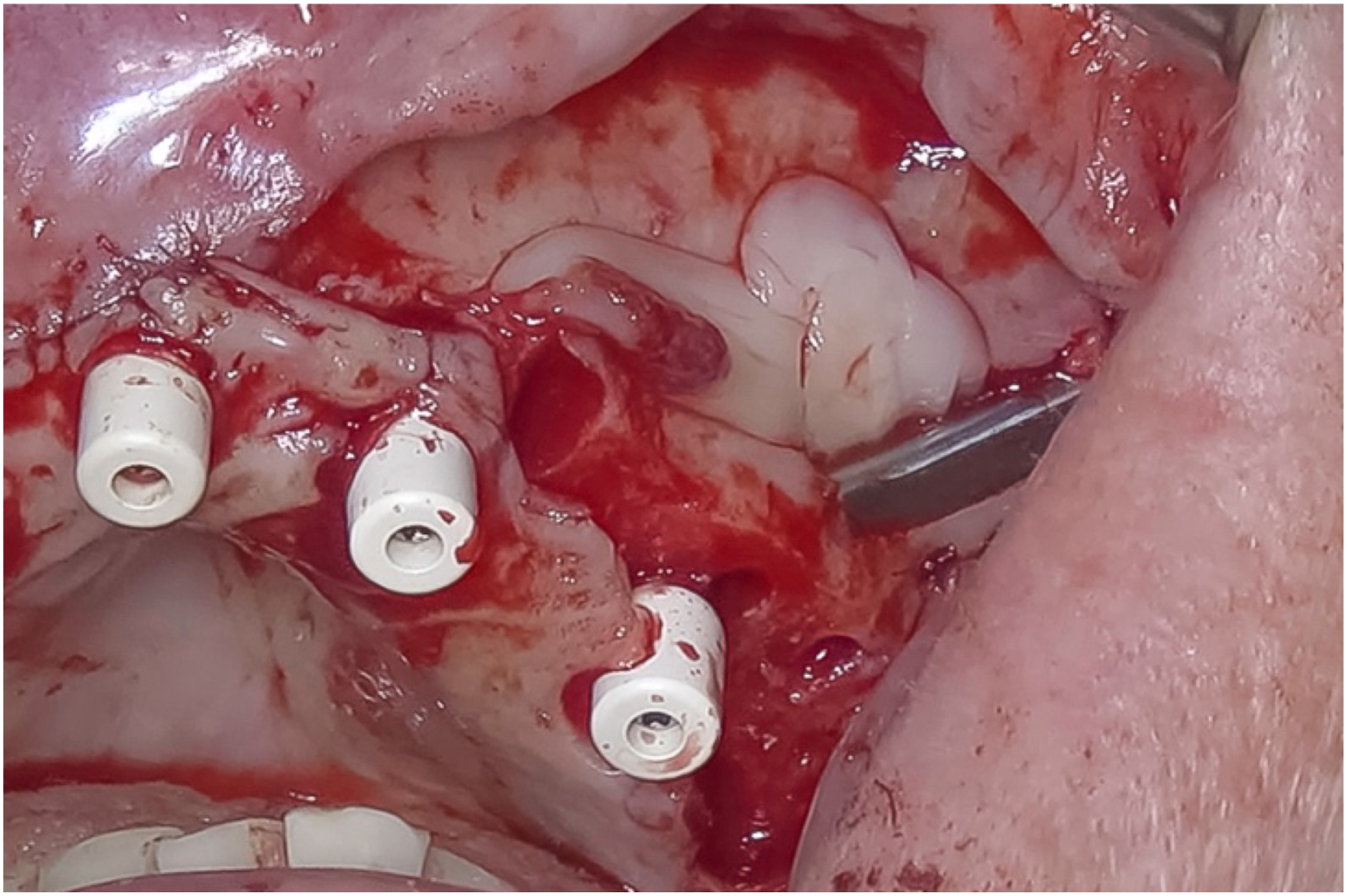 A clinical photo shows a surgical site with a material sutured in place near cylindrical implants and a metal instrument.