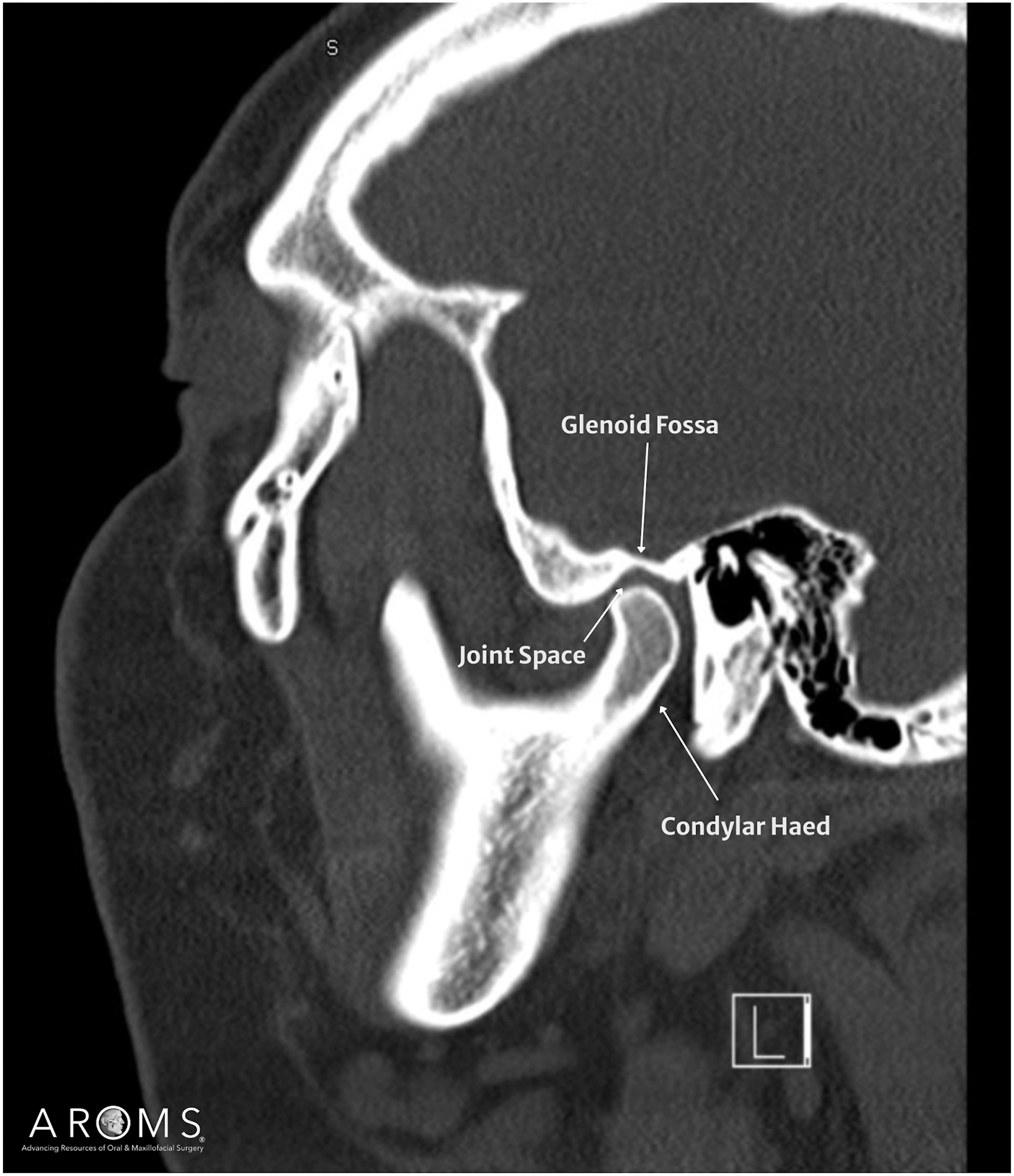 Alt text begins. An X-ray of the temporomandibular joint in sagittal view with labeled glenoid fossa, joint space, and condylar head. Alt text provided by Elsevier.