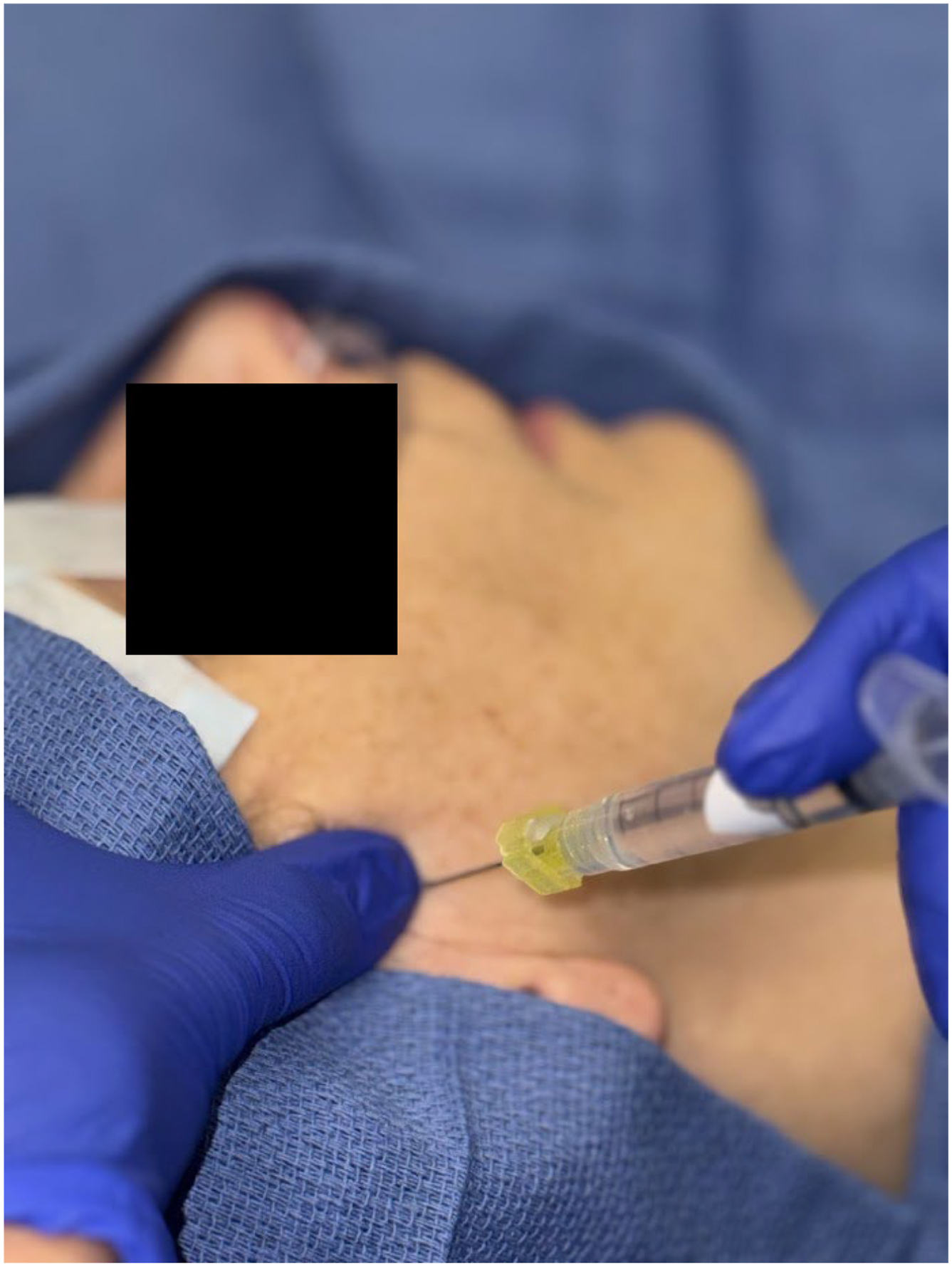 Alt text begins. A photograph depicts gloved hands performing posterior point insertion on a patient with a syringe attached to a needle inserted into the skin adjacent to the ear along the lateral facial region. Alt text provided by Elsevier.
