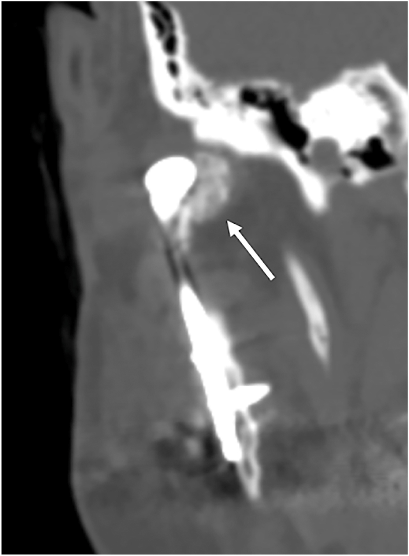 Alt text begins. A computed tomography scan shows a bright temporomandibular joint implant with an arrow pointing to a mass of periprosthetic heterotopic ossification medial to it. Alt text provided by Elsevier.