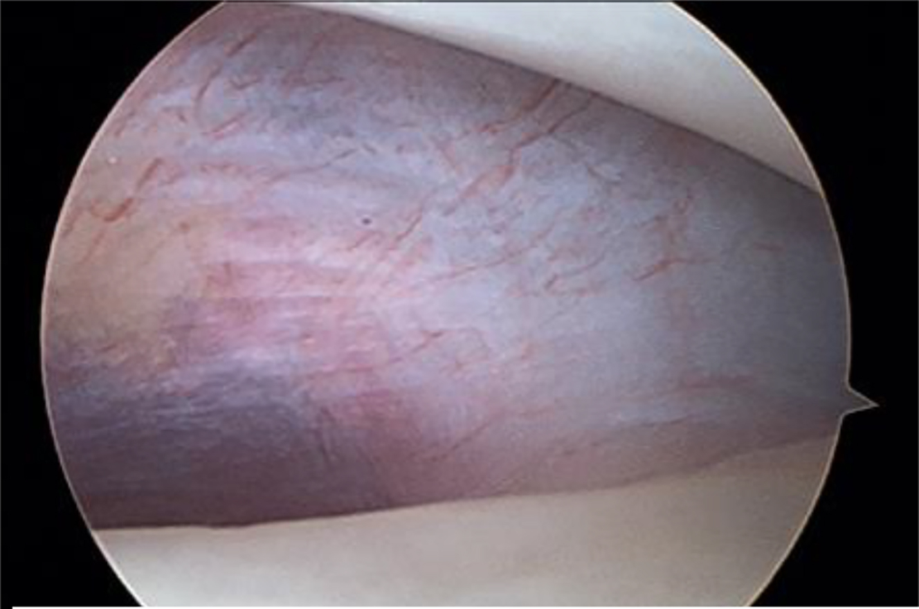 Alt text begins. An arthroscopic image of an intra-articular cavity illustrating the pterygoid shadow region anterior to the medial synovial lining in a temporomandibular joint procedure. Alt text provided by Elsevier.
