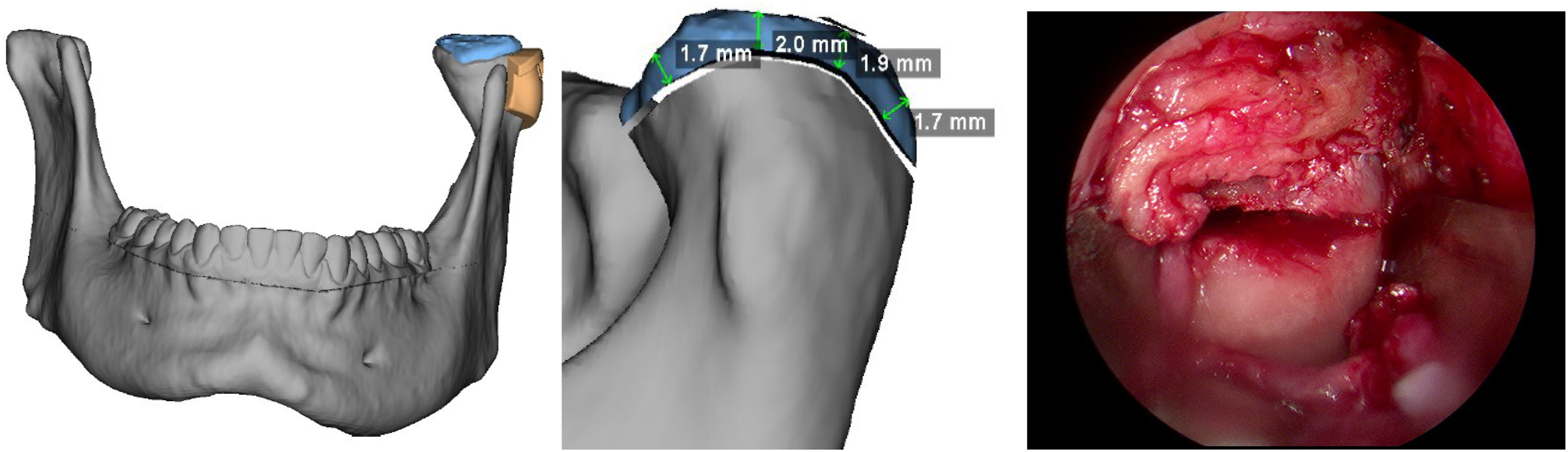 Alt text begins. A three-panel virtual surgical planning and endoscopic operative views show projected condylectomy measurements and a completed condylectomy cut. Alt text provided by Elsevier.