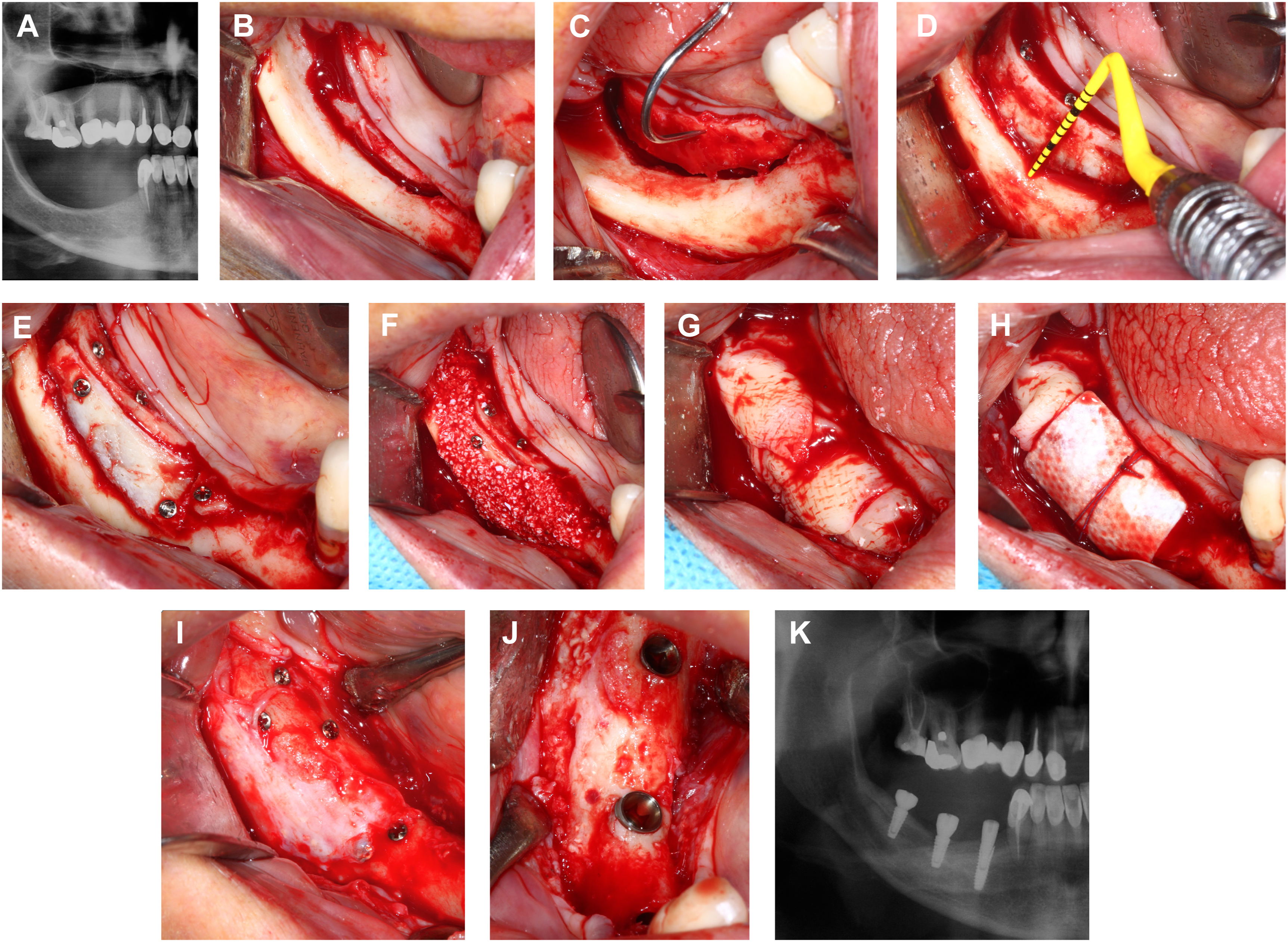 A set of eleven panels labeled A to K shows sequential mandibular grafting, fixation, and postoperative radiographs.