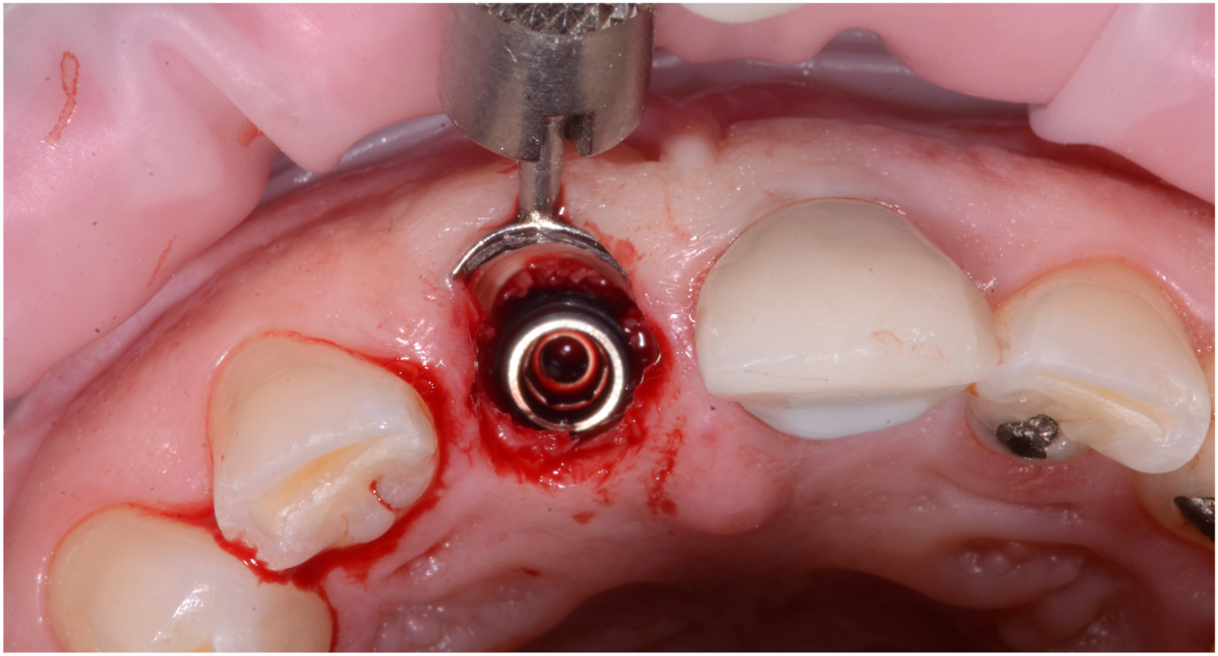An occlusal view of an upper front tooth during implant placement, where a dental drill positions an implant inside the prepared site, with nearby teeth and slight bleeding around the gum line.