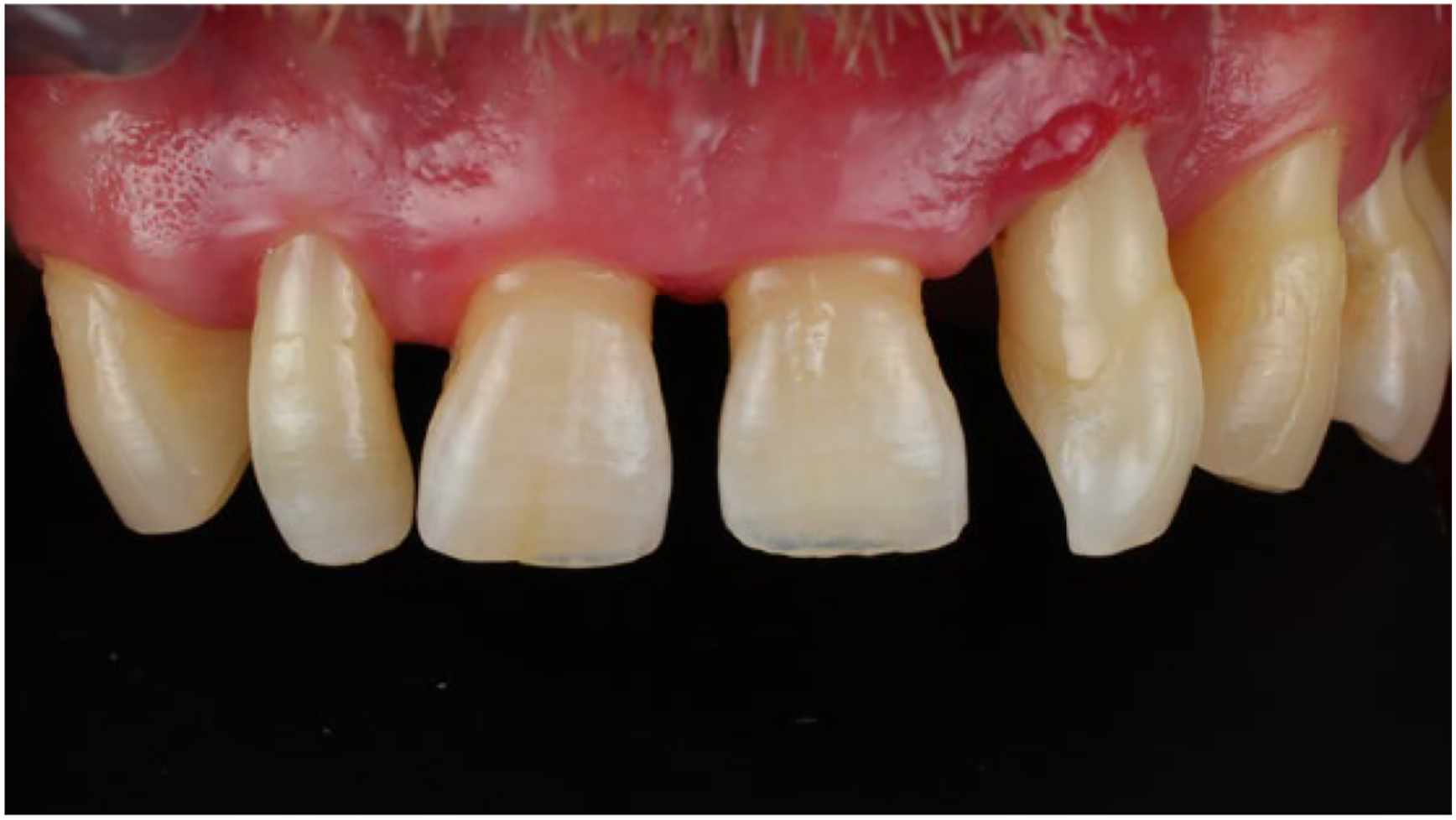 A clinical photo shows a close-up view of a patients upper front teeth with severe loss of hard and soft tissue at the cervical margin.