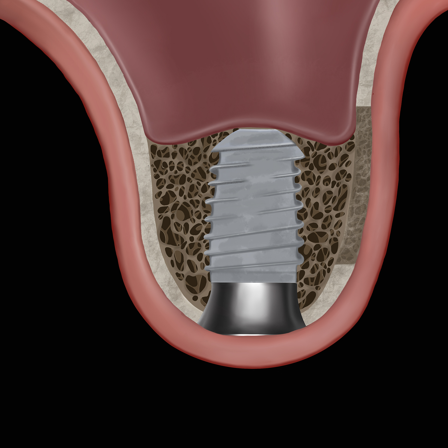 A clinical illustration shows an early bone formation around a dental implant and sinus stabilizer abutment in the maxillary sinus 3 to 6 months after sinus elevation.