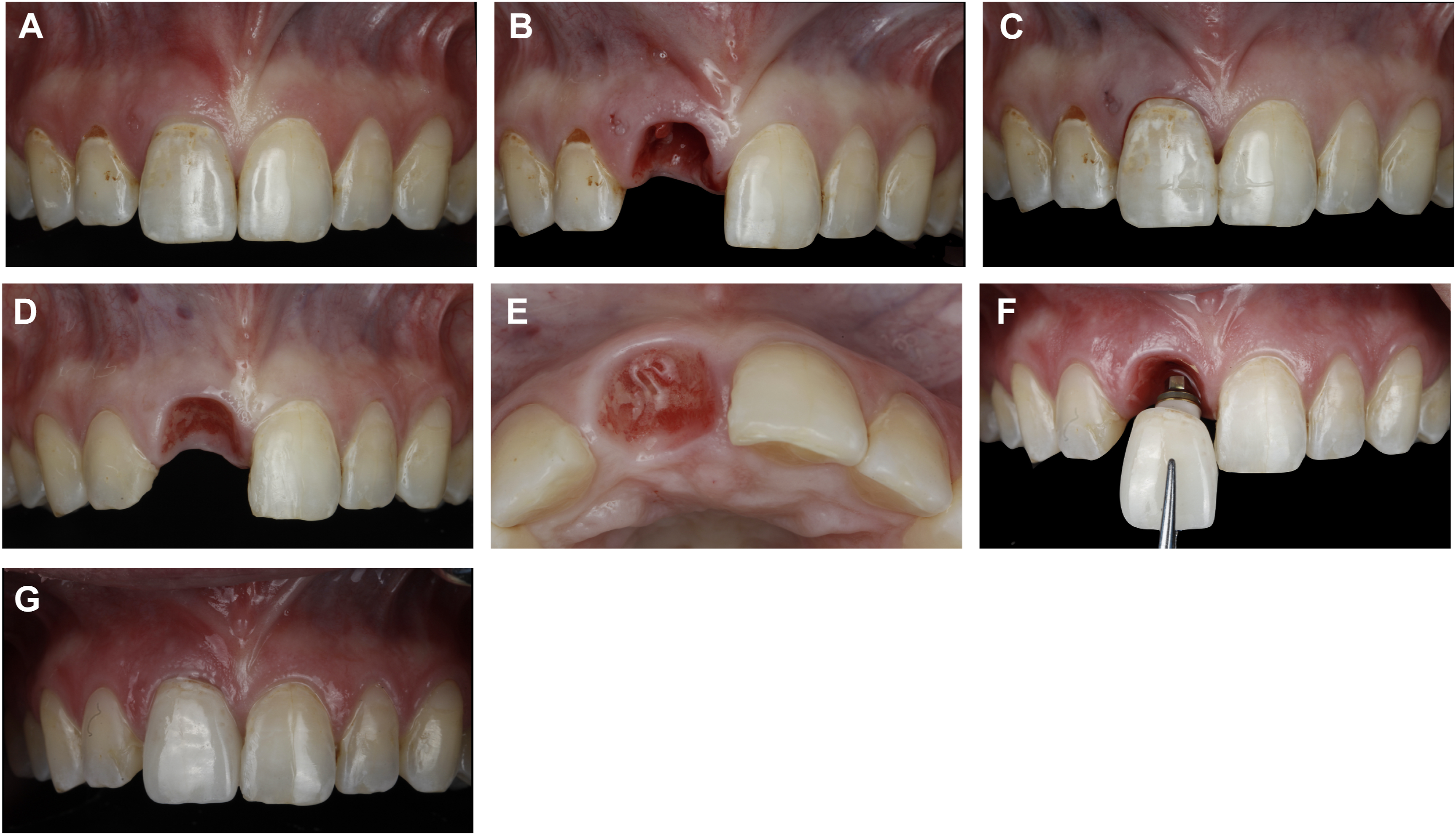 A set of seven dental views shows a dental implant procedure, from the extraction of a discolored tooth and placement of a temporary pontic, to the insertion of the final, natural-looking crown.