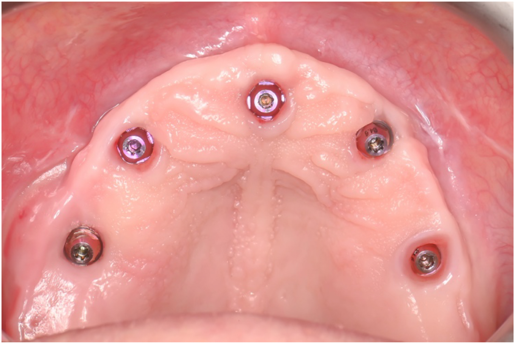 A photo of a mouth with five implants from left to right.
