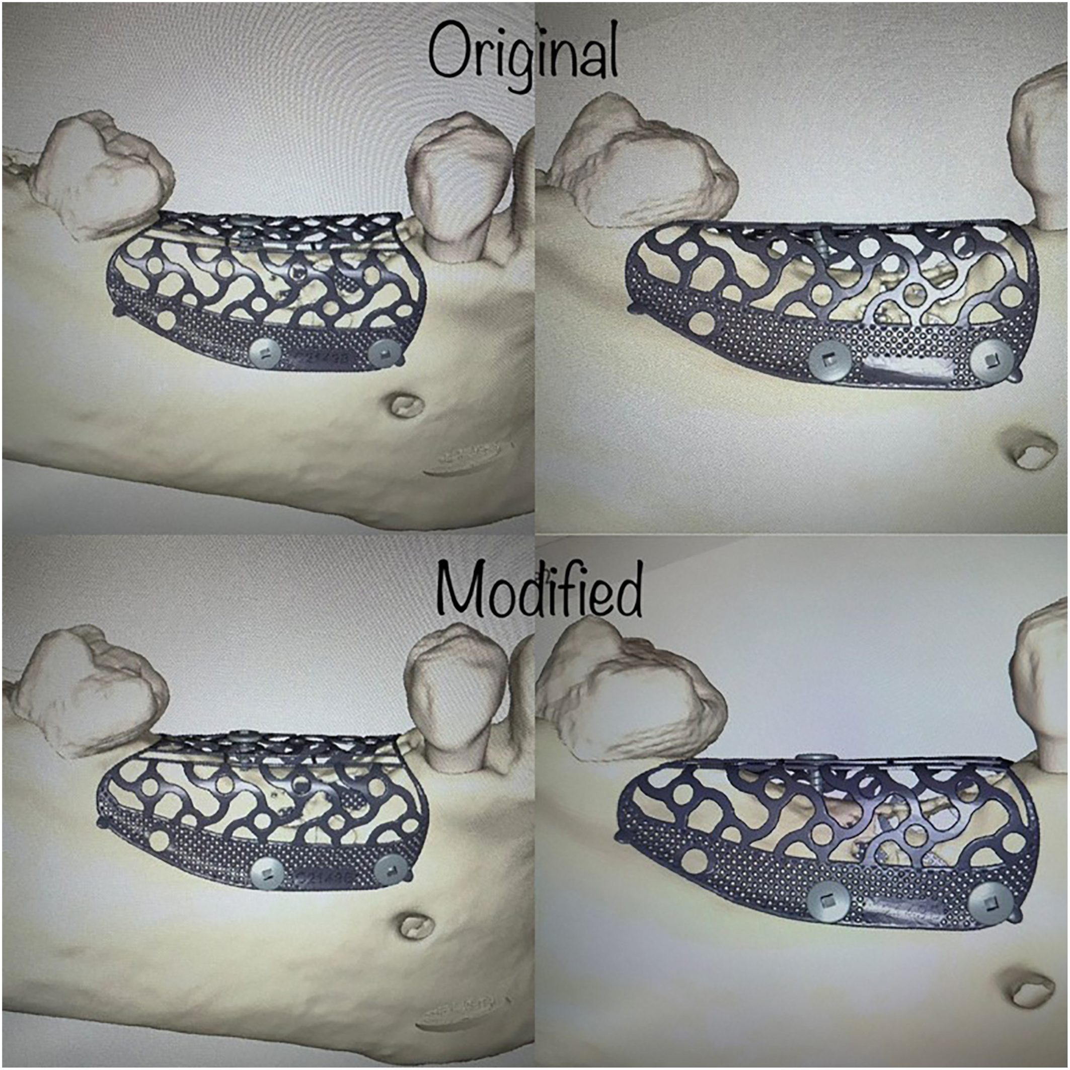 A set of four panels shows original and modified mandibular mesh designs with fixation screws positioned along the alveolar ridge.