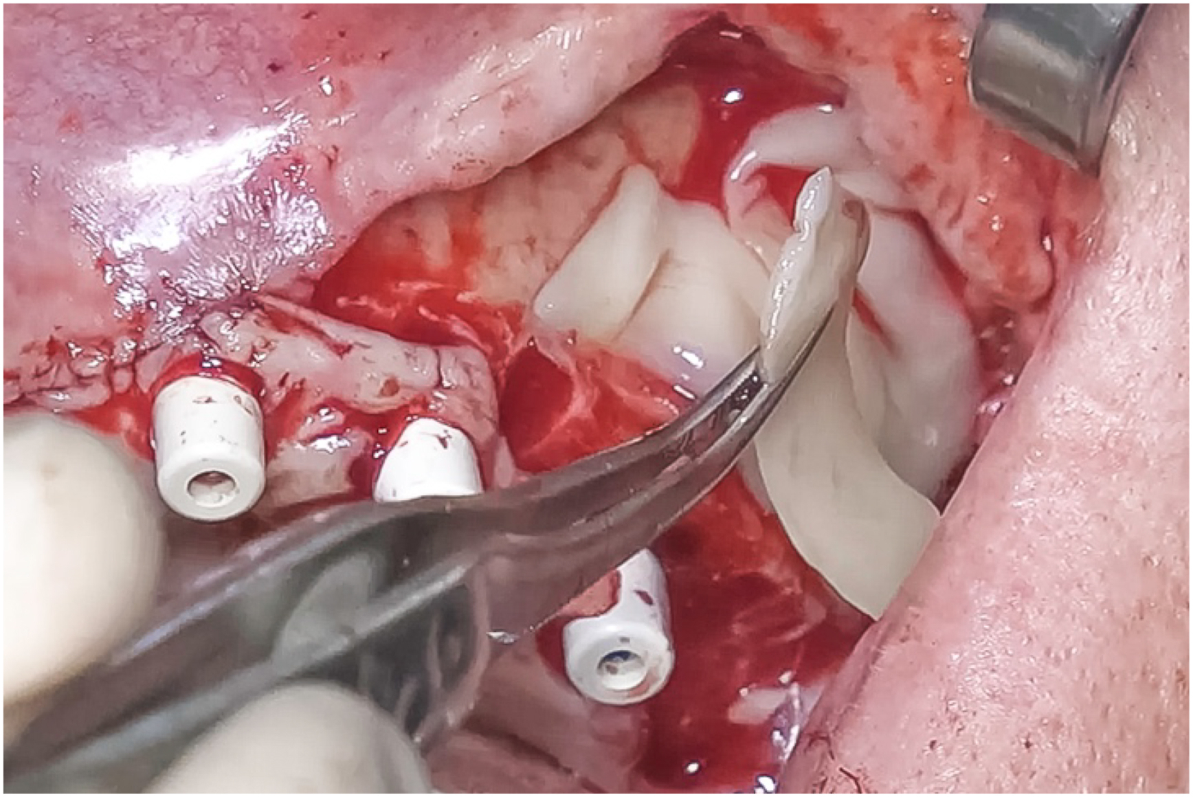 A clinical photo shows P R F applied on the buccal aspect near light-shaded cylindrical implants, with a metal instrument holding material and a hand visible during the procedure.