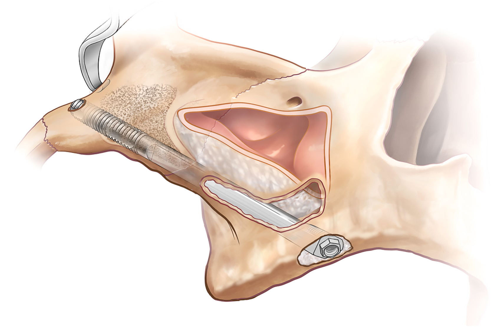 Cutaway skull illustration shows sinus floor displaced upward by controlled compression, compacted bone beneath membrane, and implant positioned below elevated cavity lining.