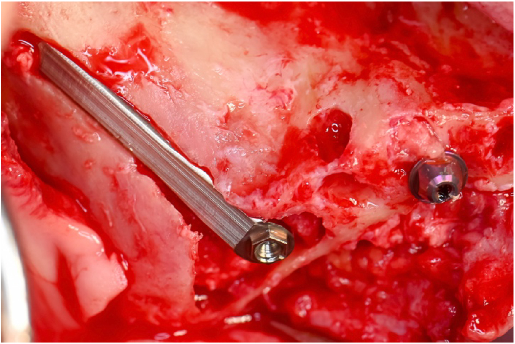 A clinical photo shows a sinus crush with a zygomatic implant suspended off the cheekbone, lacking crestal support, and a metal instrument and screw visible in the surgical site.