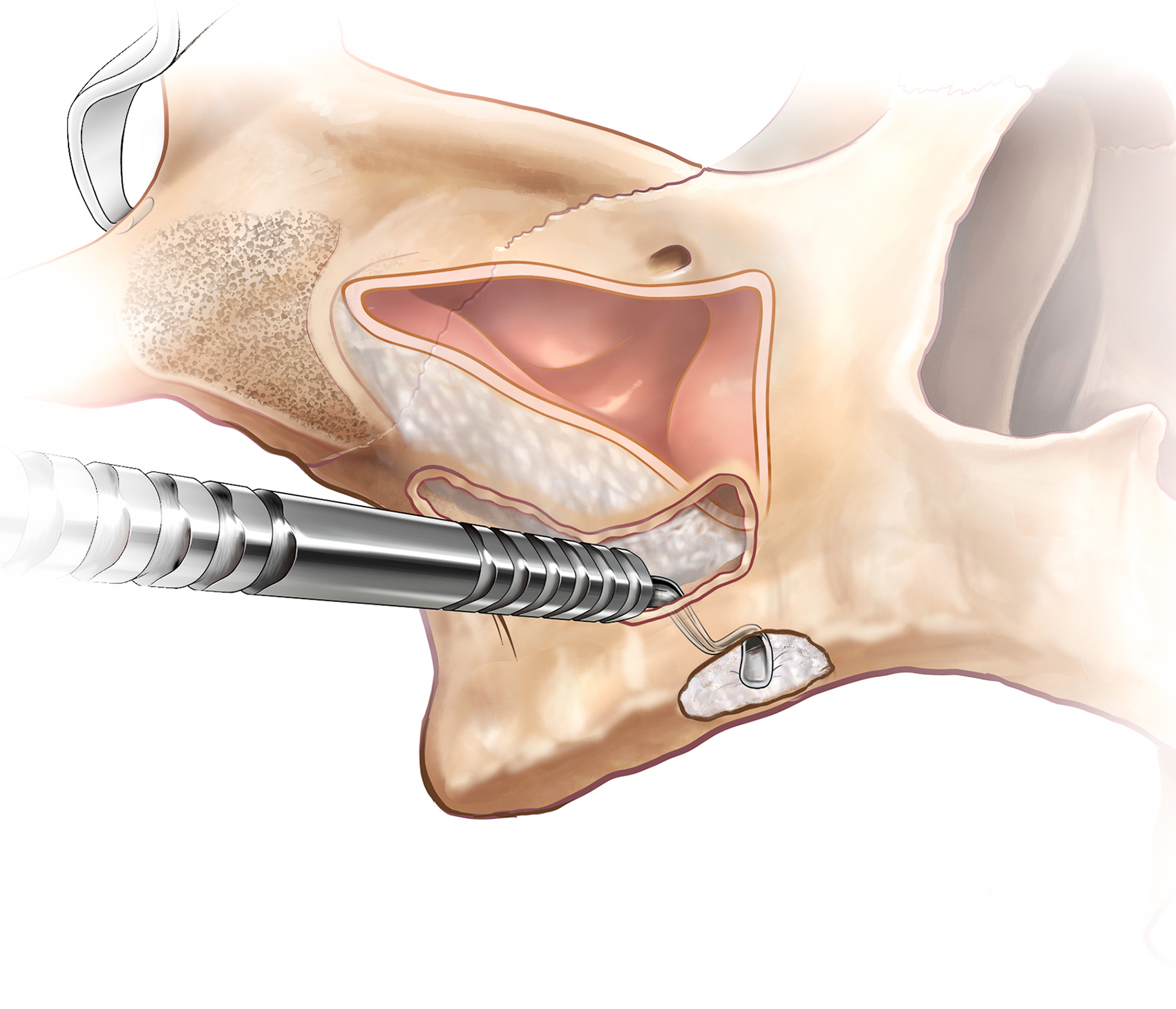Cutaway skull illustration shows curved access path beneath sinus cavity, elevated sinus membrane along cavity wall, crestal opening at ridge, and implant trajectory guided by modified bone contour.