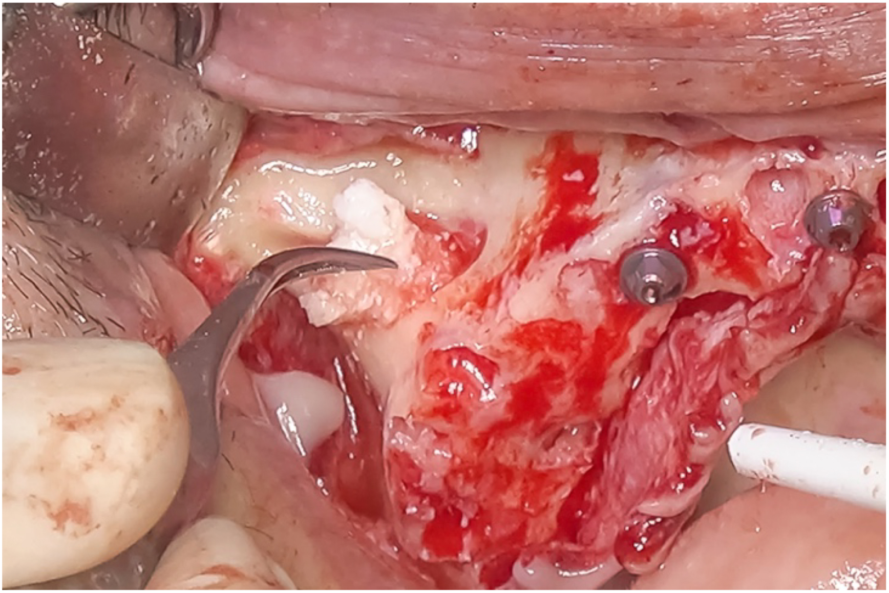 A clinical photo shows a Hockey Stick approach with BioOss bone grafting applied, featuring two screws and a metal instrument in a surgical site with exposed tissue.