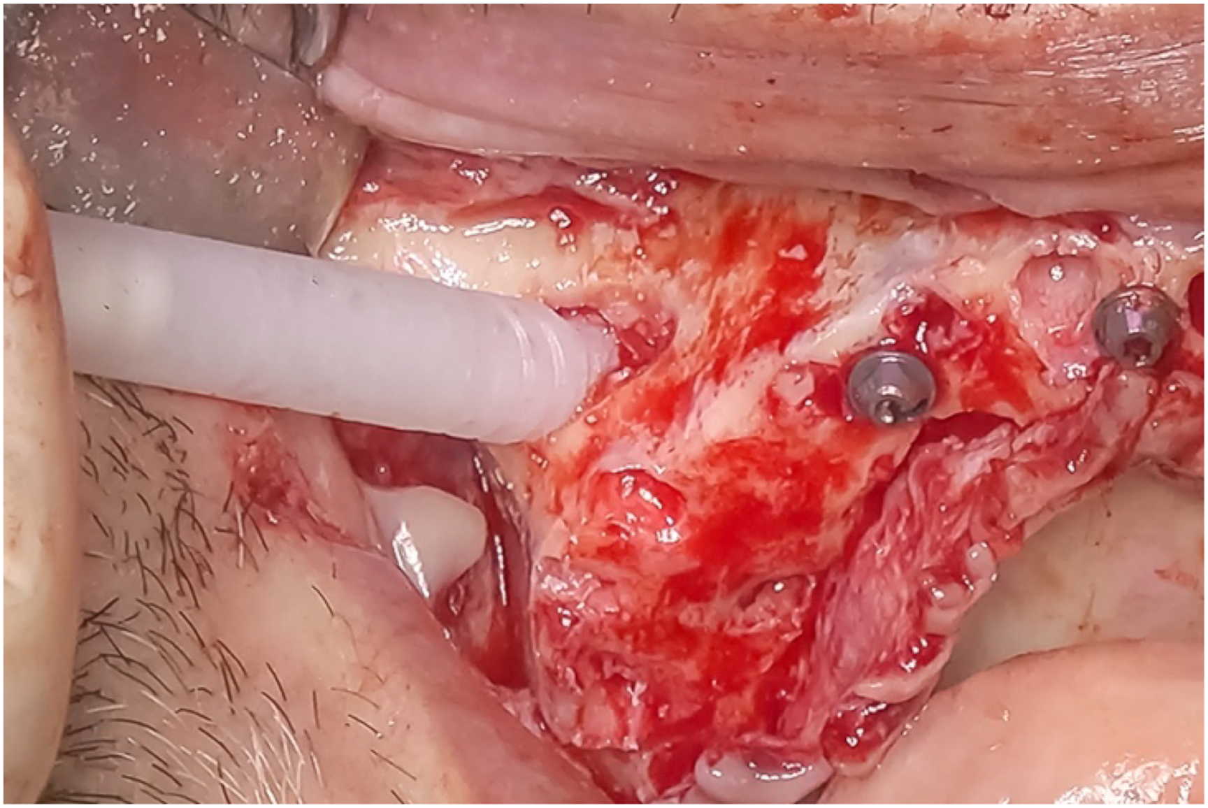 A clinical photo shows NanoBone applied to provide a stiffer base, with two screws and a tube visible in a surgical site with exposed tissue.