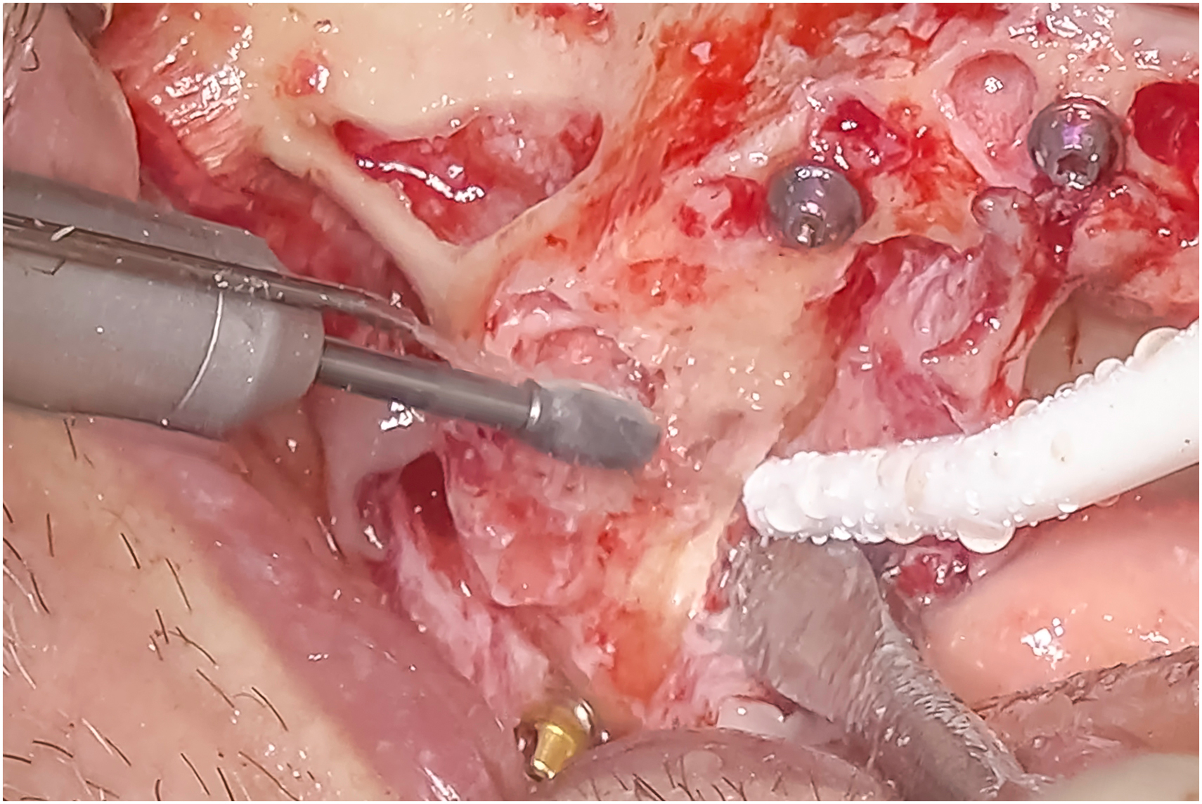 A clinical photo shows a sinus grafted and protected, with a Sinus Crush cutting back crestal bone through the sinus space, and the graft visible through the crestal opening.