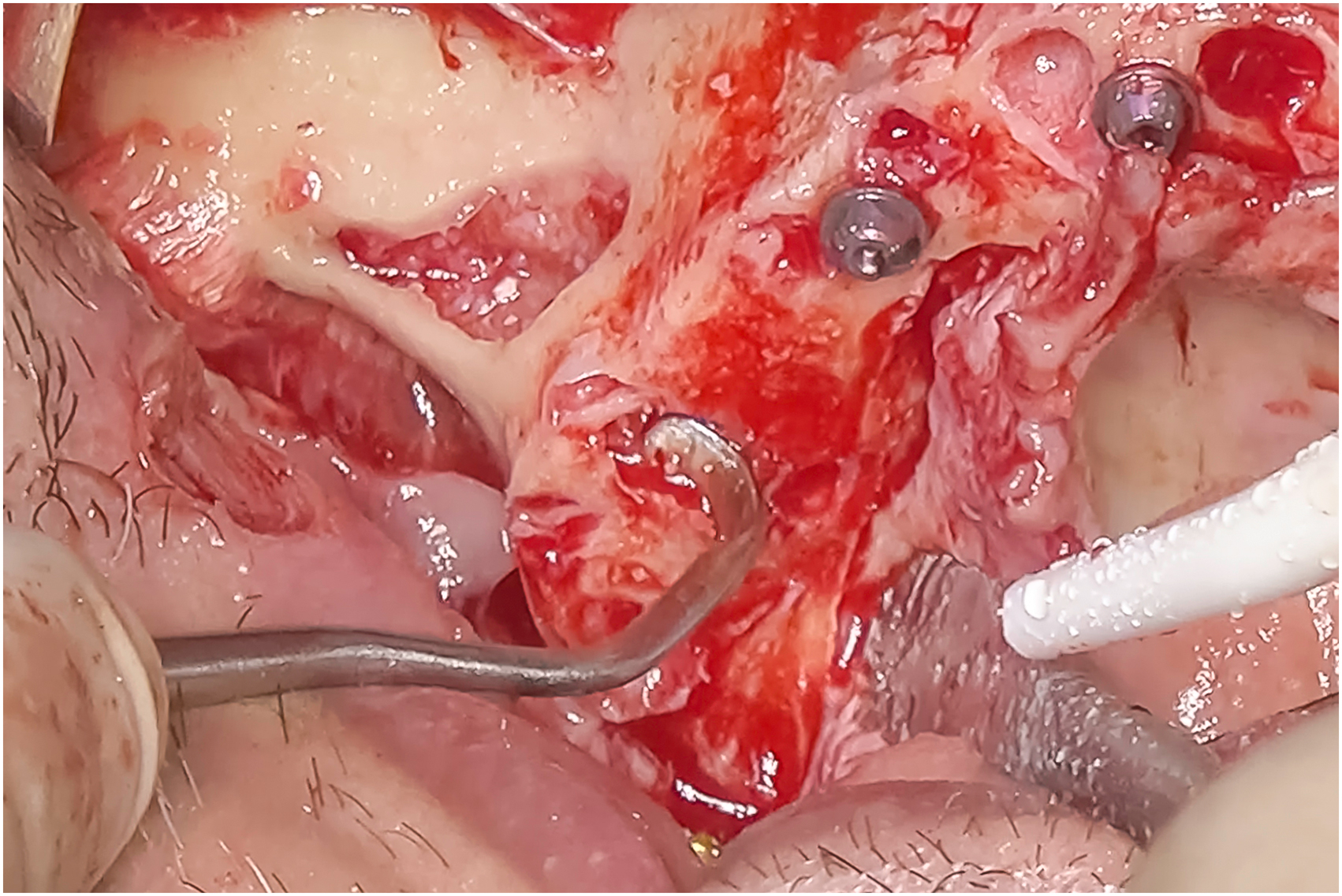 Intraoral surgical view shows crestal opening with elevated sinus membrane, curved instrument reflecting membrane upward, exposed implant heads, and graft area remaining unobstructed.