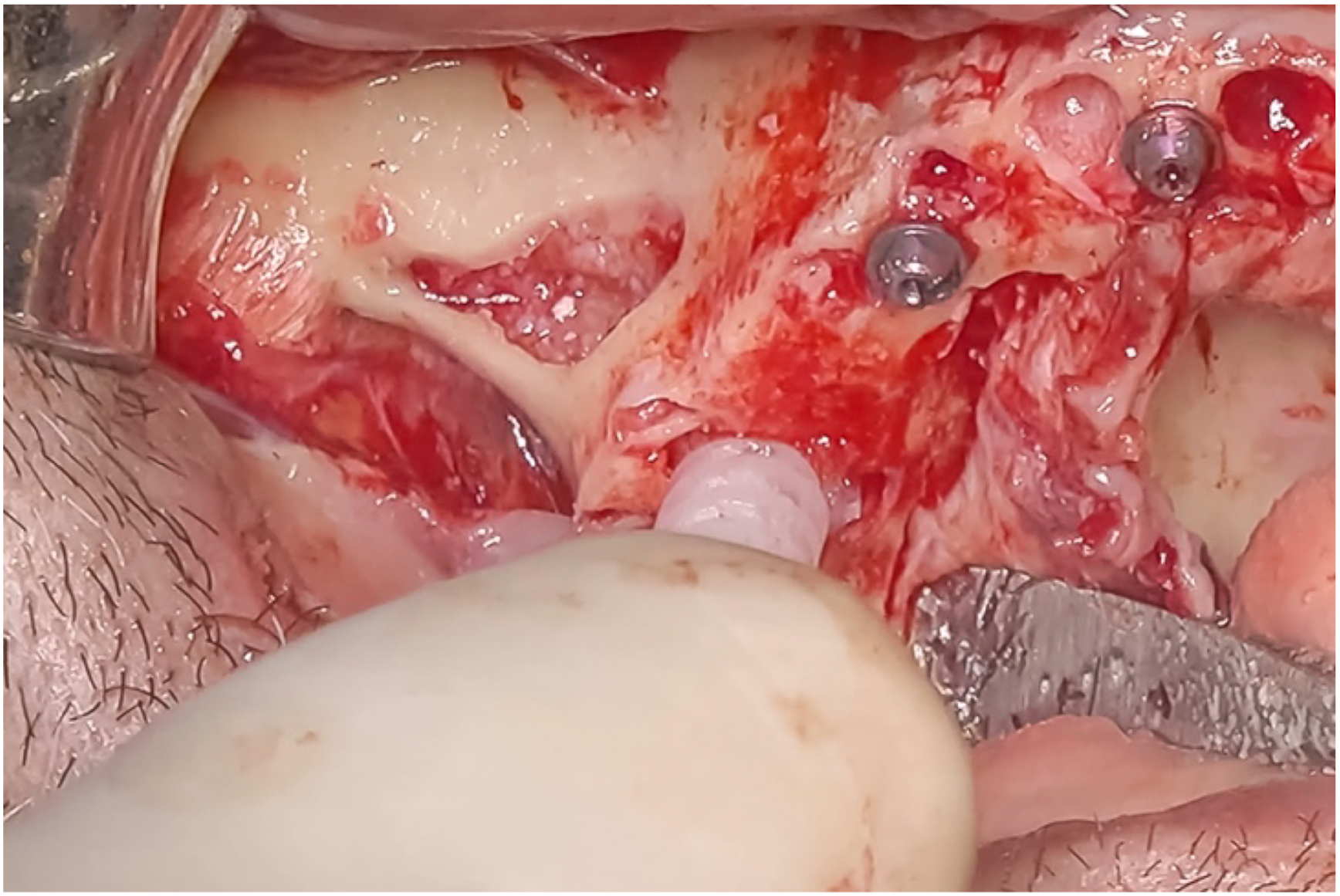 A clinical photo shows NanoBone applied to provide a firmer base for drilling, with two screws and a tube visible in the surgical site.