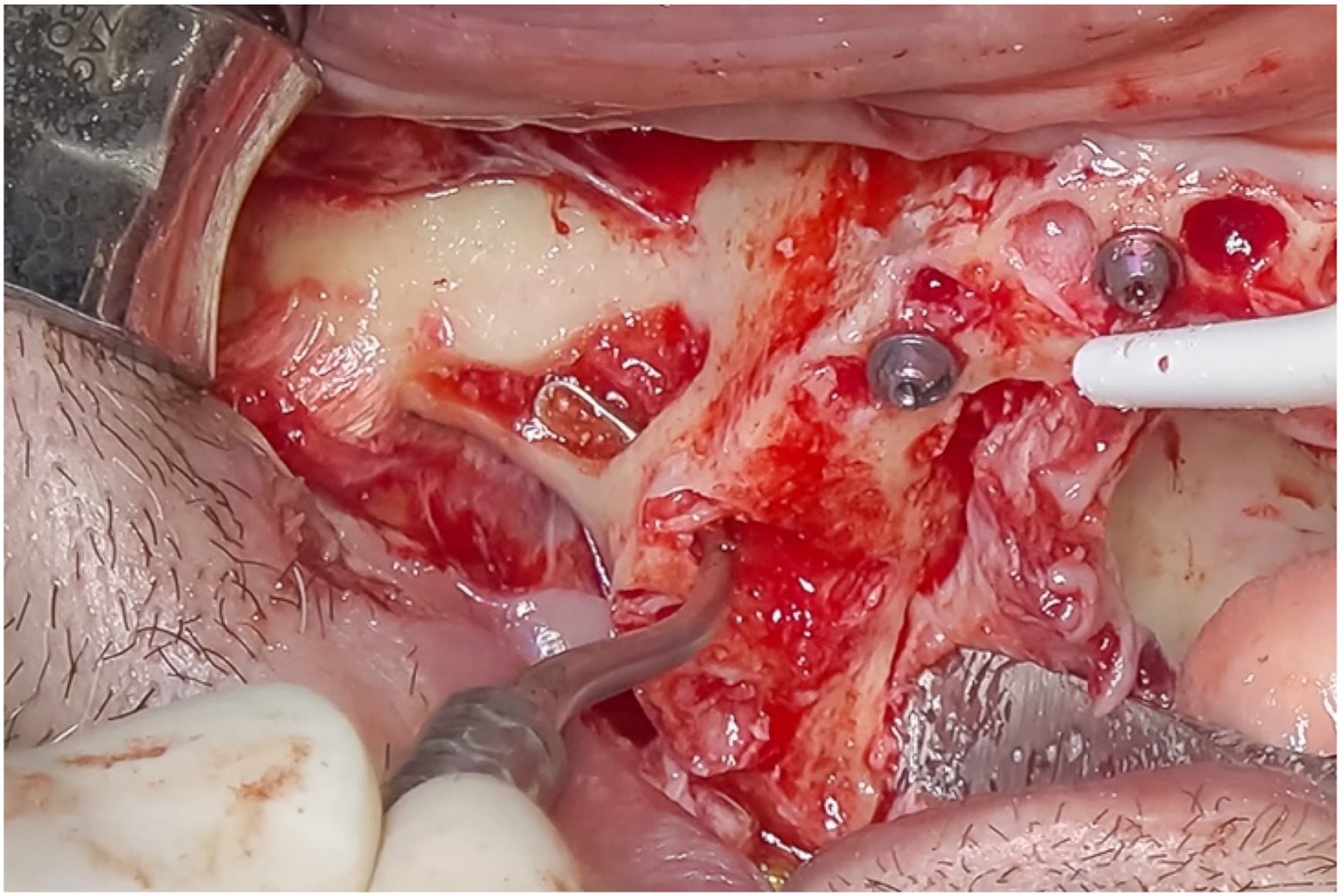 A clinical photo shows a bone graft lightly compressed through a crestal opening before drilling, with two screws and a metal instrument visible in the surgical site.