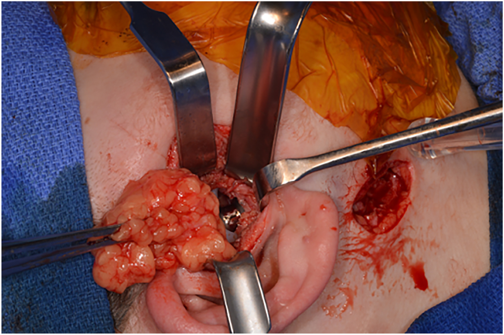 Alt text begins. A surgical photograph of the preauricular area shows retractors holding open an incision where the metallic prosthesis is visible and an autologous fat graft is held by forceps. Alt text provided by Elsevier.