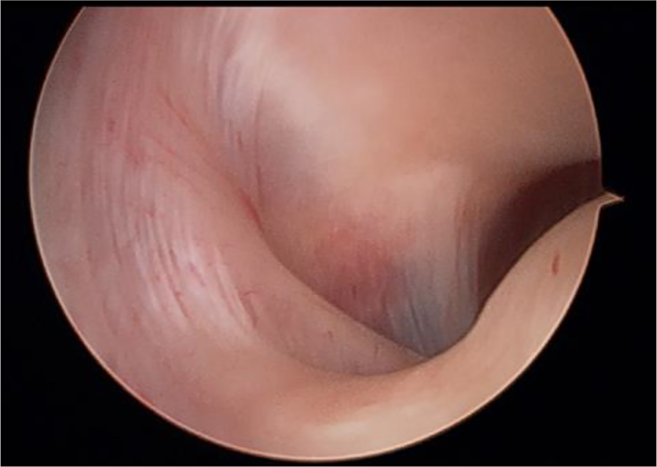Alt text begins. An arthroscopic image of an intra-articular cavity illustrating the retrodiscal synovial region with an oblique protuberance and disc synovial junction in a temporomandibular joint procedure. Alt text provided by Elsevier.