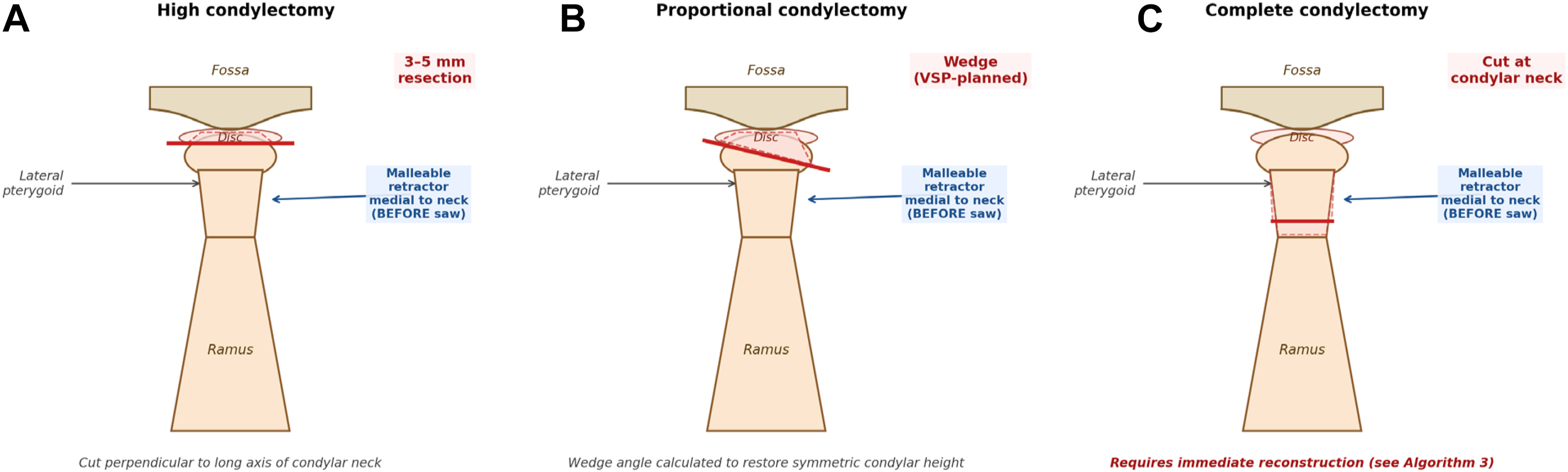 Alt text begins. A three-panel diagram compares the orientations of high, proportional, and complete condylectomy osteotomy with medial malleable retractor placement before sawing. Alt text provided by Elsevier.