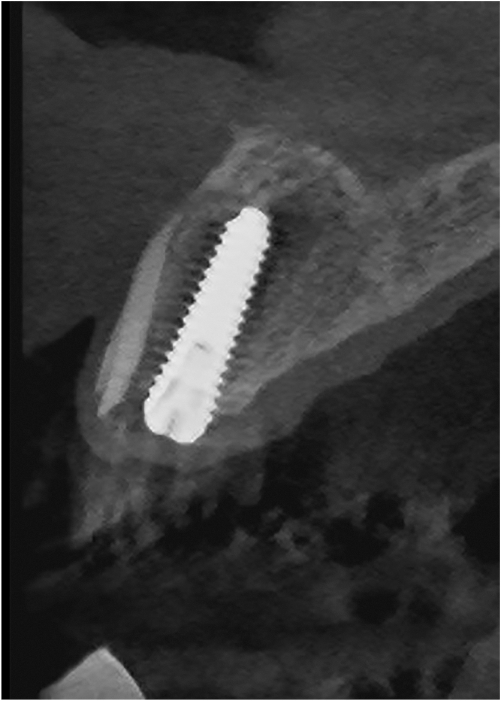 A sagittal dental scan shows a screw shaped implant within the jawbone surrounded by dense graft material along the upper and outer sides.