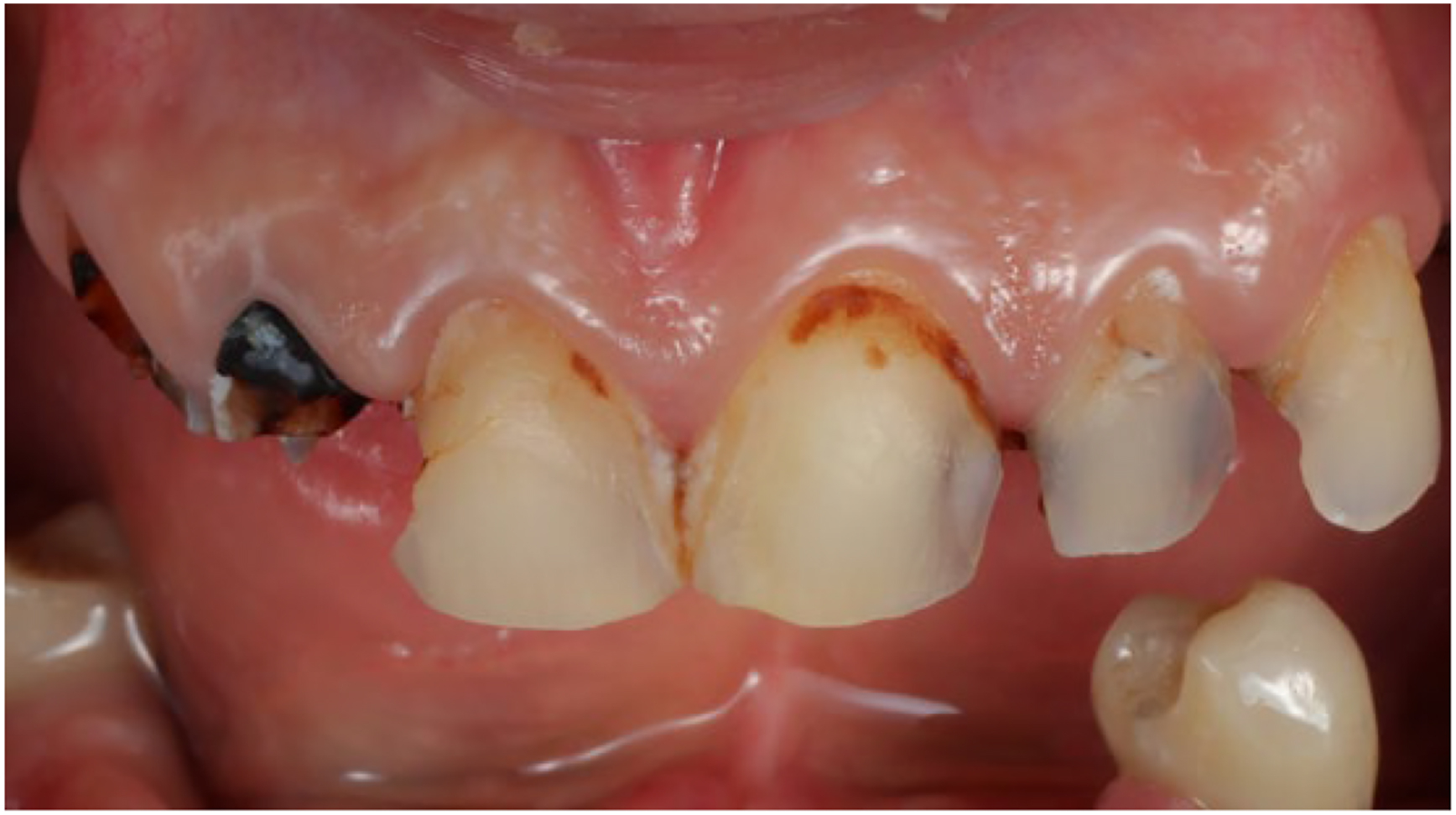 A clinical photo shows a close-up view of a patients upper front teeth with minimal loss of hard and soft tissue at the cervical margin.