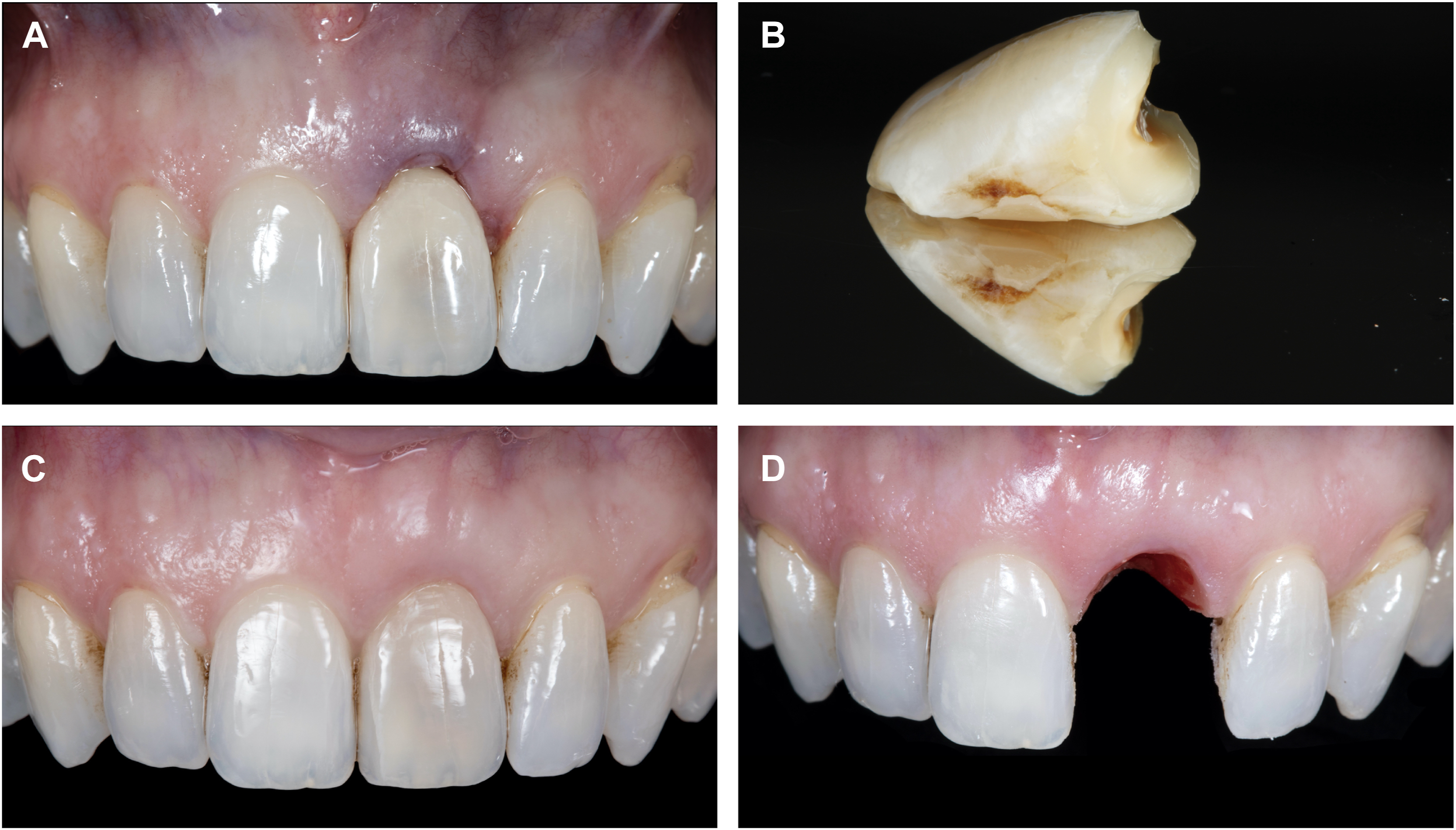 A set of four photographs shows a step-pontic design. The panels show the pontic in place, the fabricated pontic from the extracted crown, the matured gum tissue, and the final healed socket.