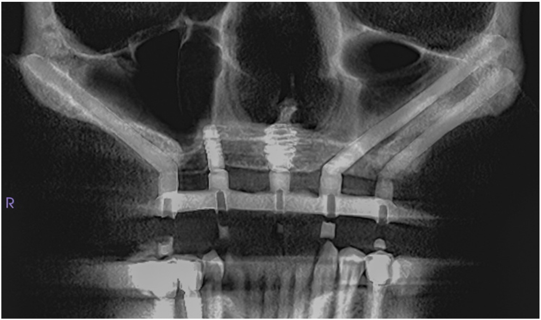 A radiographic image of a jaw with three implants.