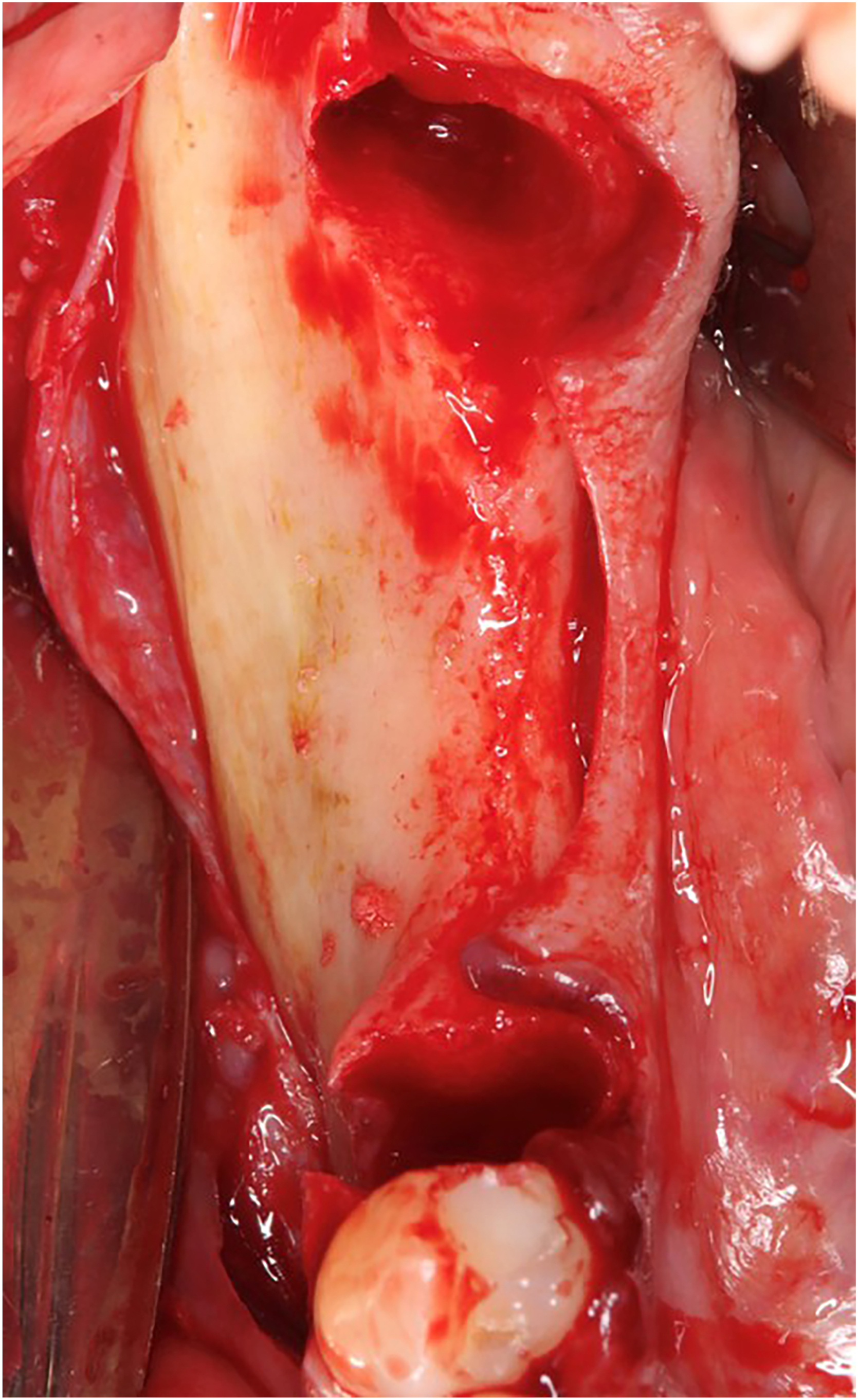 A view shows an exposed mandibular surgical area with a bone defect between adjacent tooth sockets prepared for placement of a customized mesh design.
