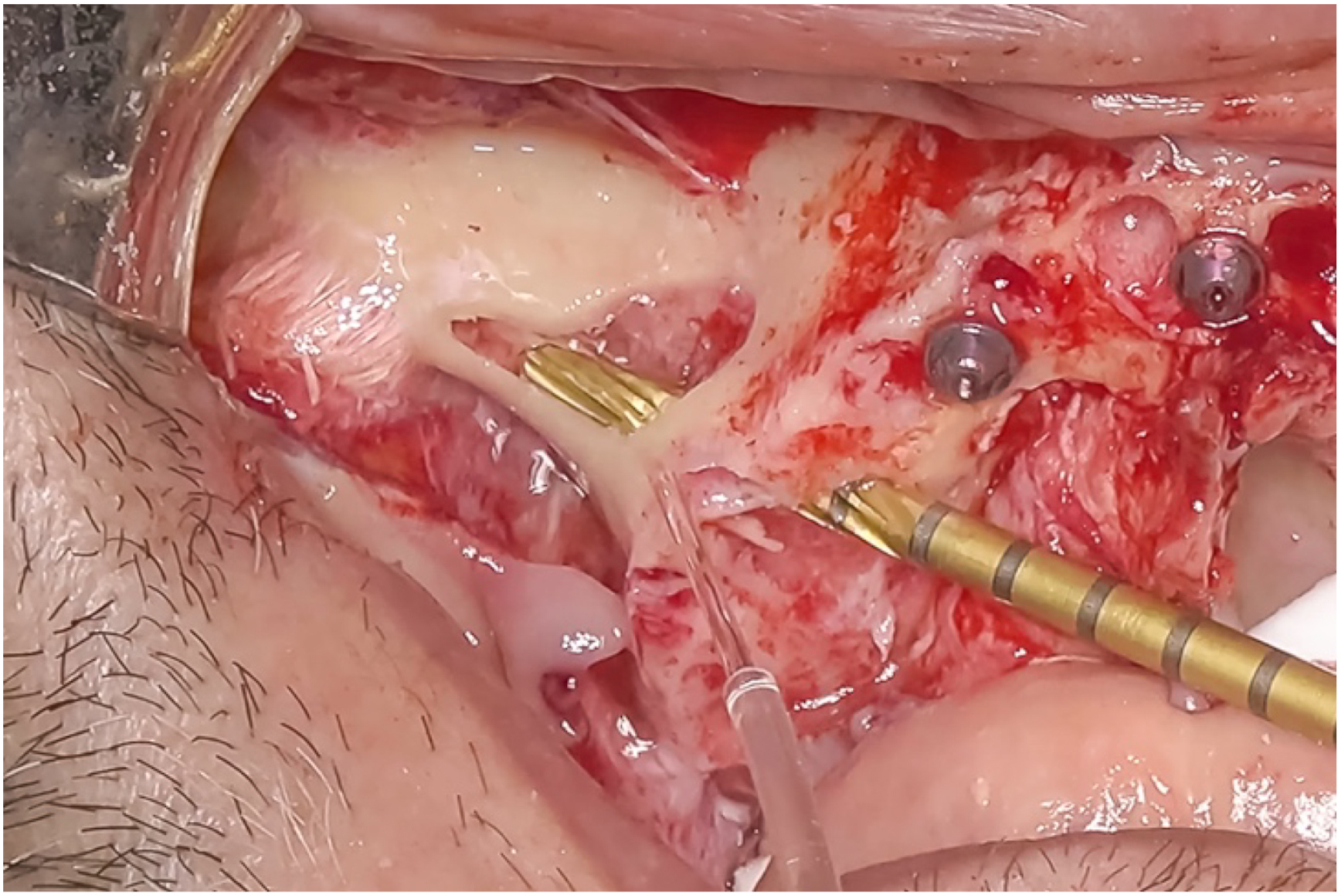 A clinical photo shows an osteotomy performed using the Zygomatic Implants Precision Osteotomy sequence, with two screws and a metal instrument visible in the surgical site.