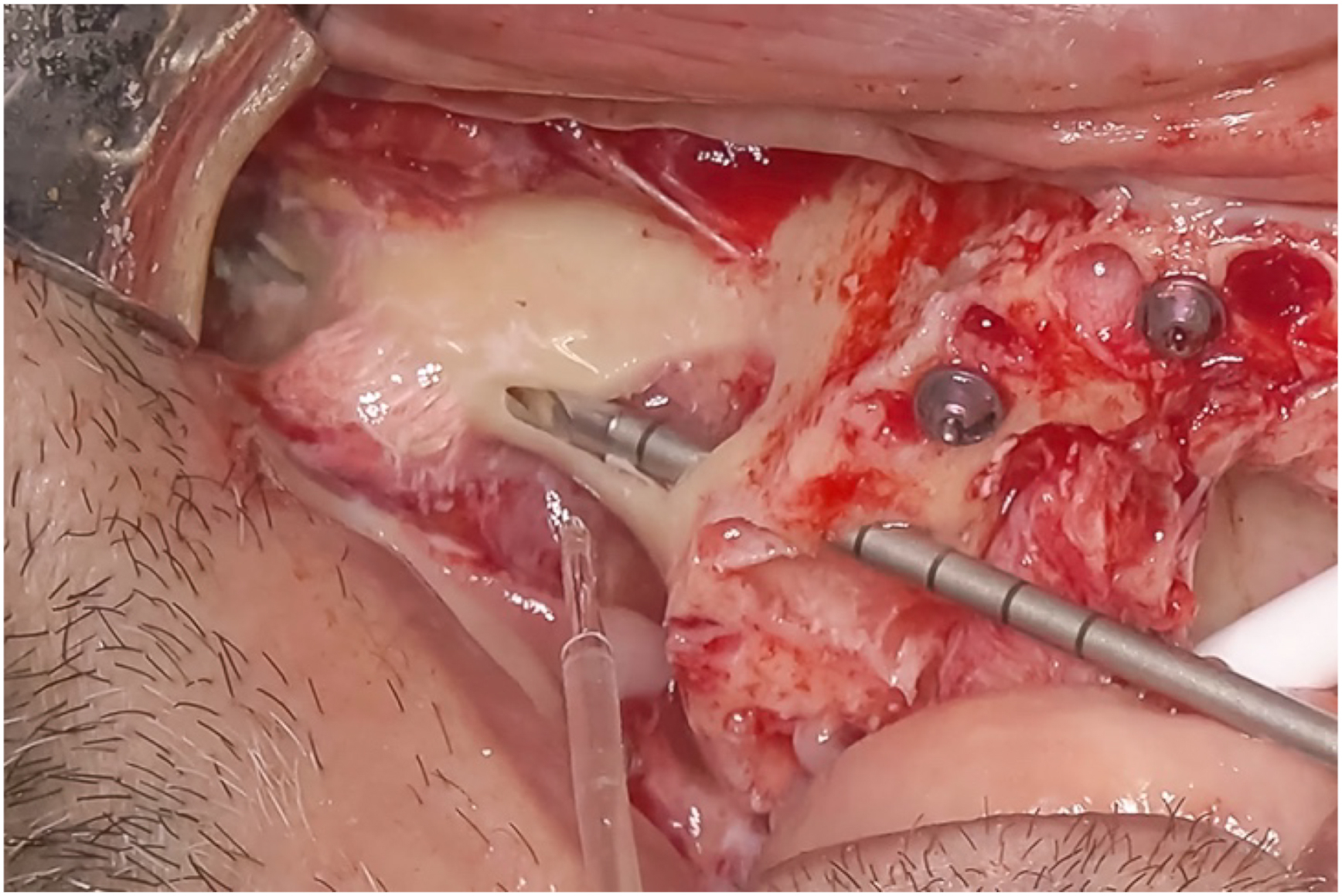 A clinical photo shows a completed osteotomy without disturbing the graft or traumatizing sinus tissues, with two screws and a metal instrument visible in the surgical site.