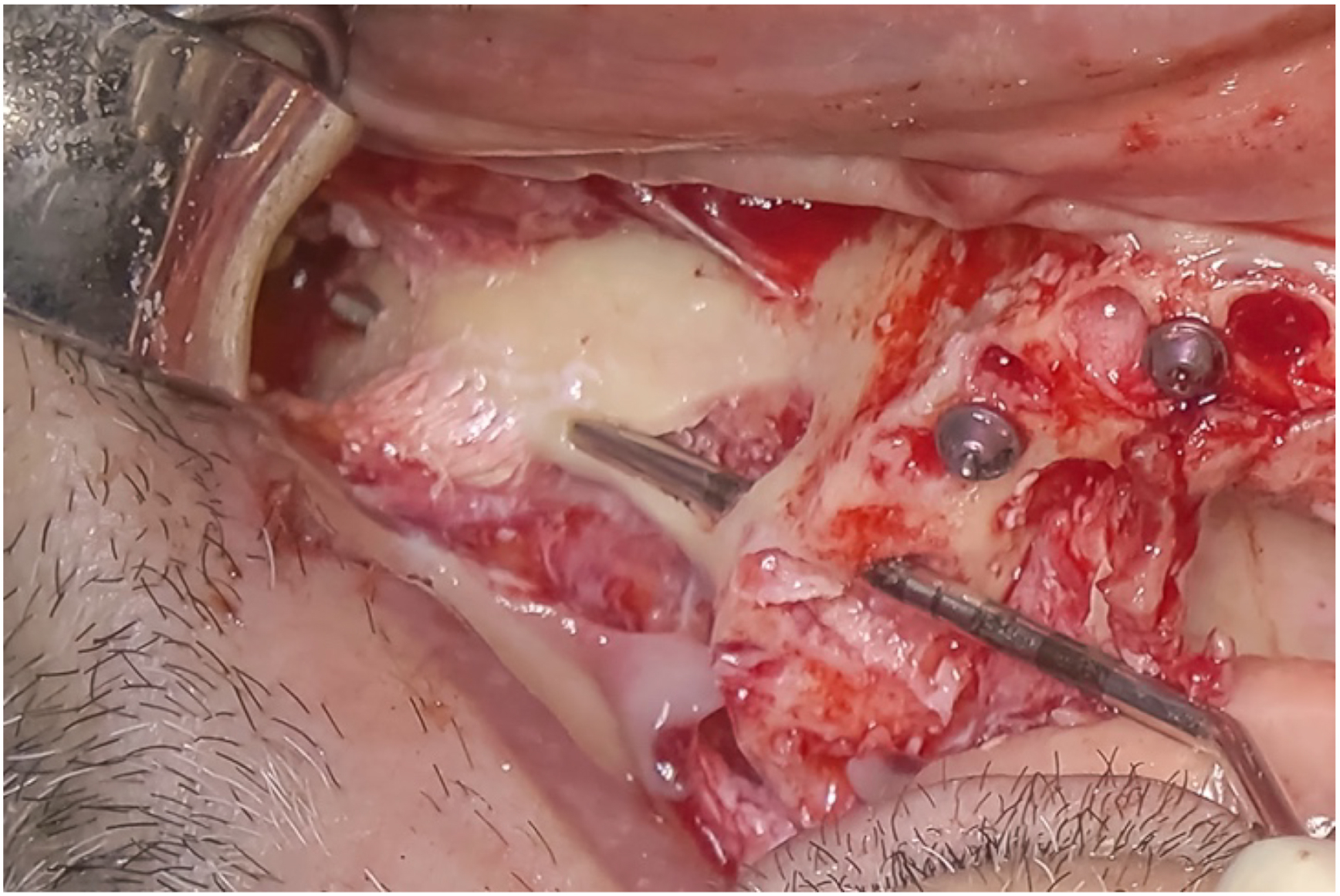 A clinical photo shows a depth gauge used to ensure implant length penetrates the apical cortex for maximum stability, with two screws and a metal instrument visible.