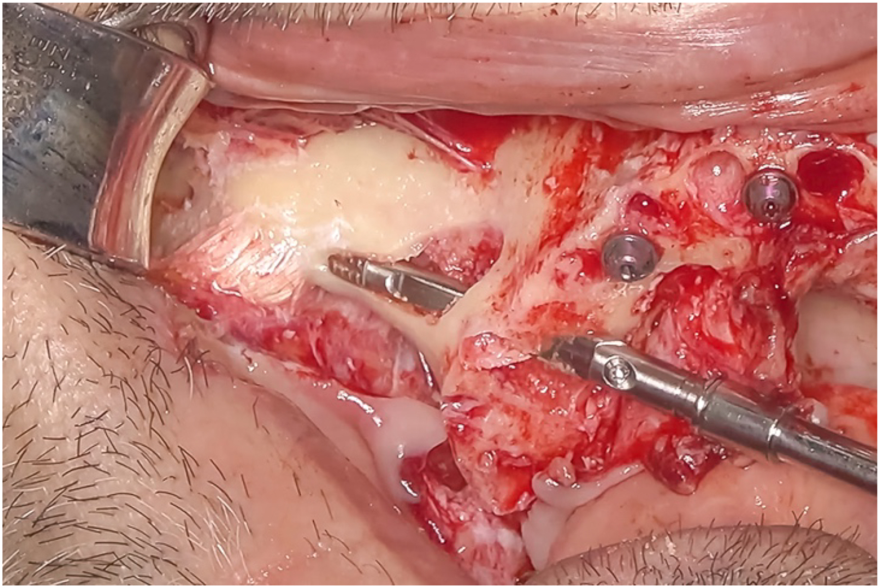 A clinical photo shows a crestal rest on the mesio-palatal aspect of the implant head, with two screws and two metal instruments visible in the surgical site.