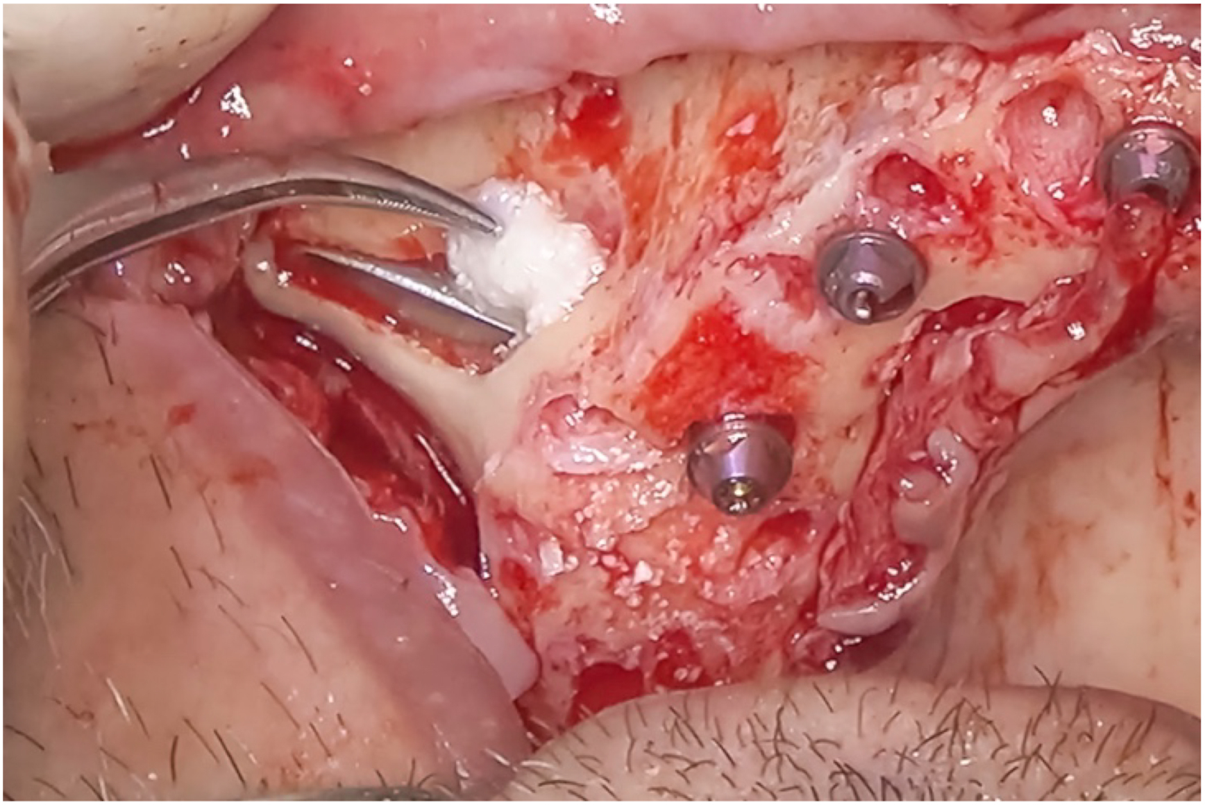 A clinical photo shows BioOss Collagen layered to fill the mesial aspect of the lateral window, avoiding the implant, with three screws and a metal instrument visible.