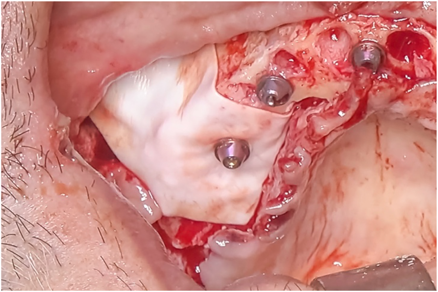 A clinical photo shows a collagen membrane placed over the implant and grafted crestal opening, with three screws visible in the surgical site.